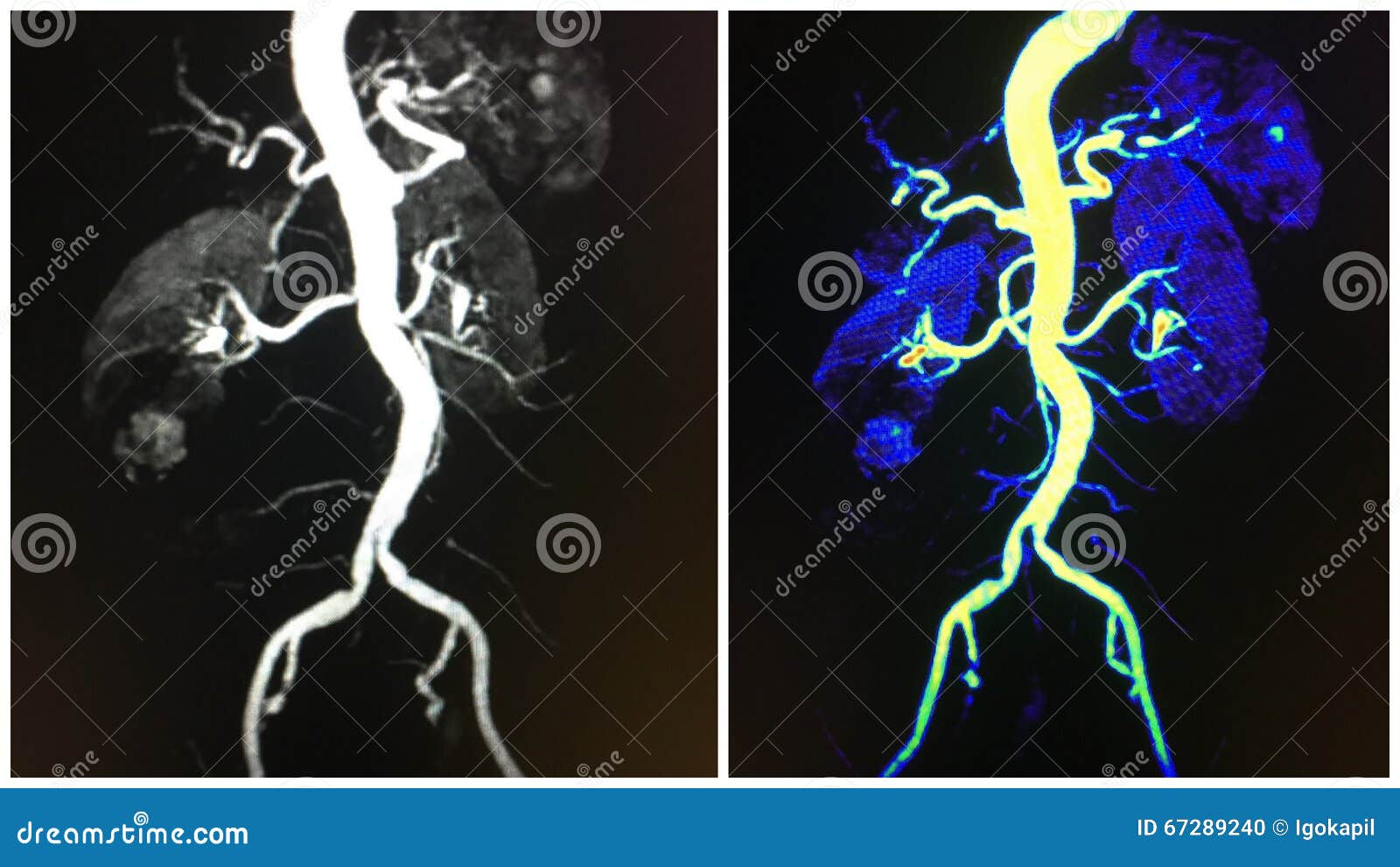aorta renal arteries kidneys mra collage