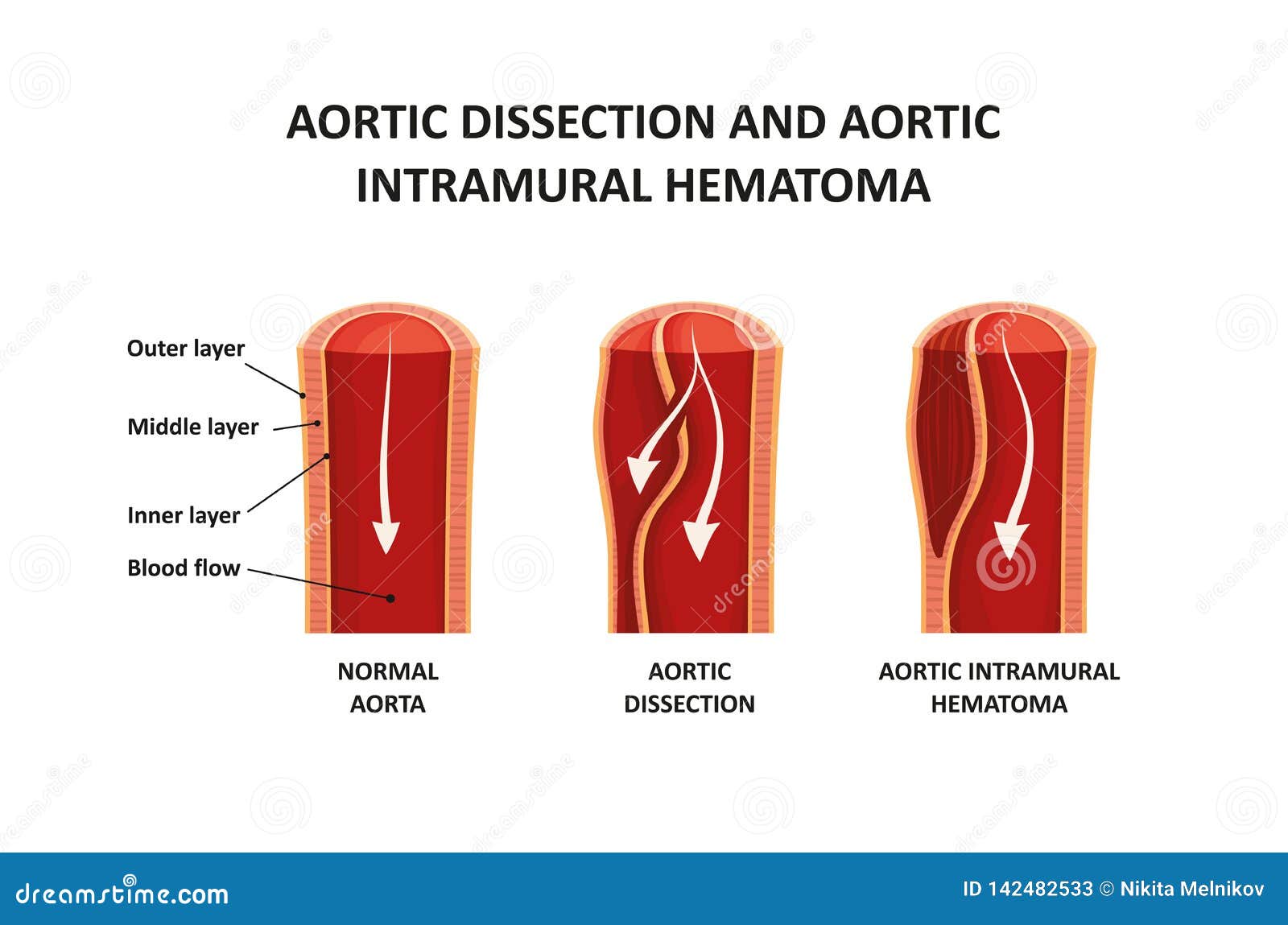 aortic dissection and aortic intramural hematoma