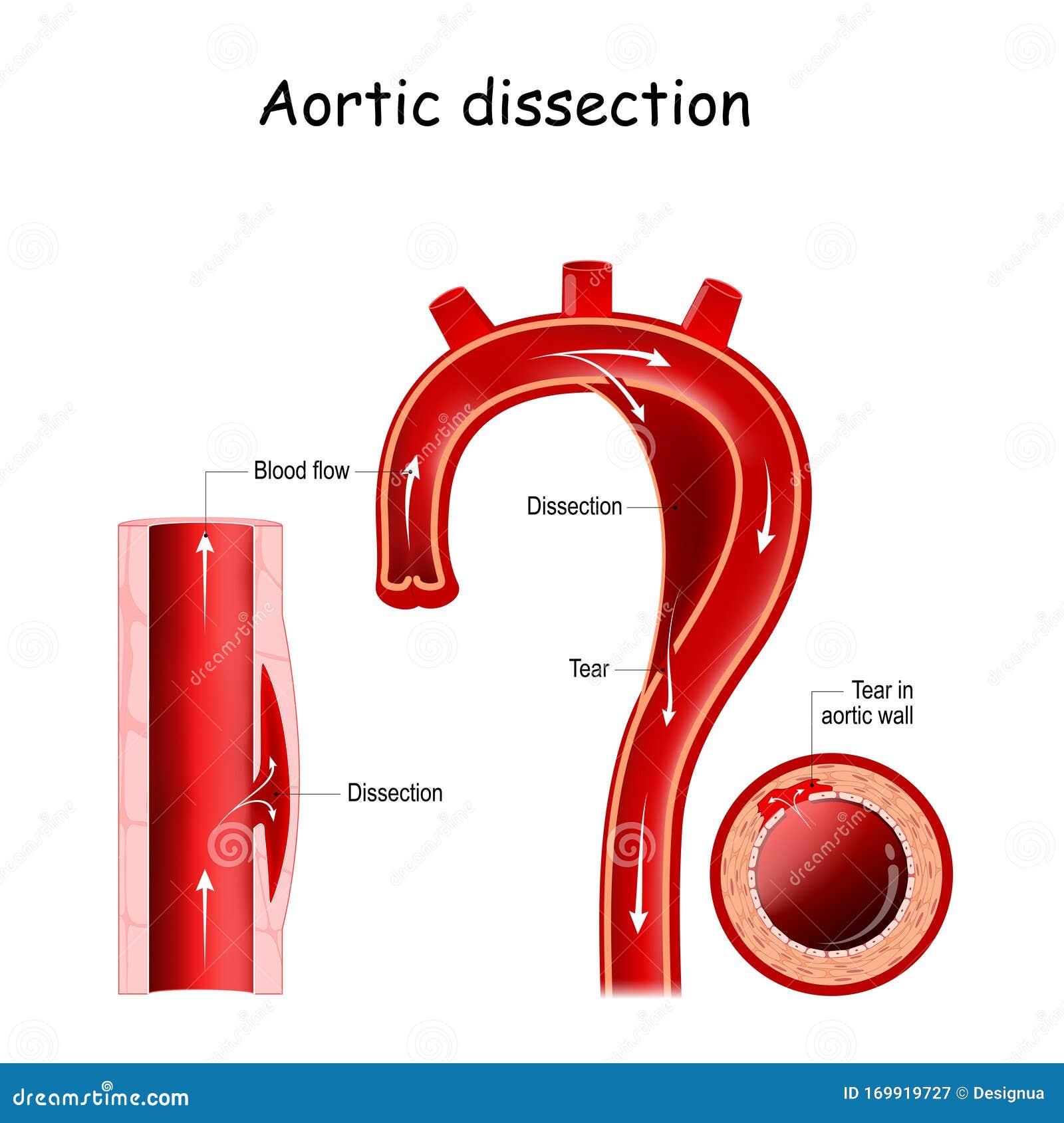 aortic dissection. longitudinal and cross-section of blood vessel.