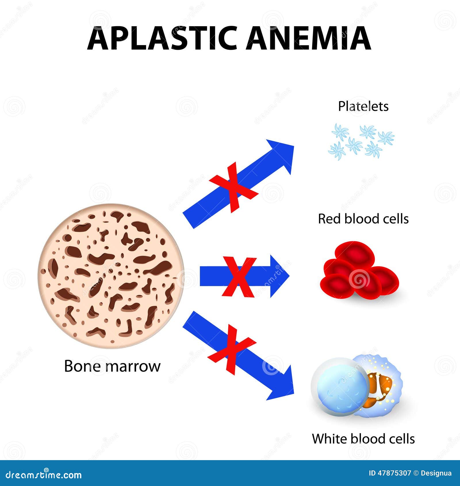 Aplastic Anemia Stock Vector - Image: 47875307