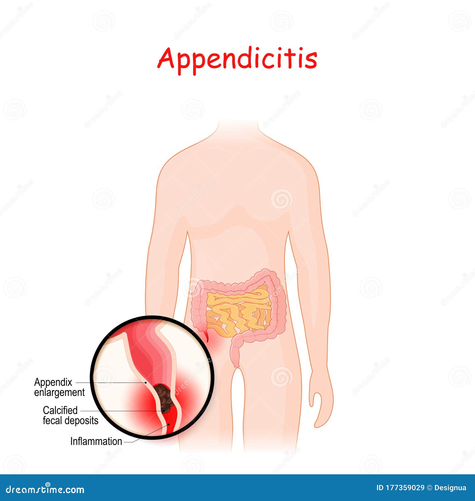 appendicitis. closeup of appendix with inflammation