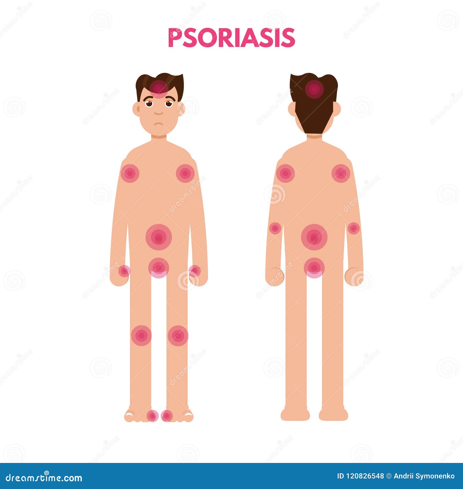 Naked Psoriasis Bilder
