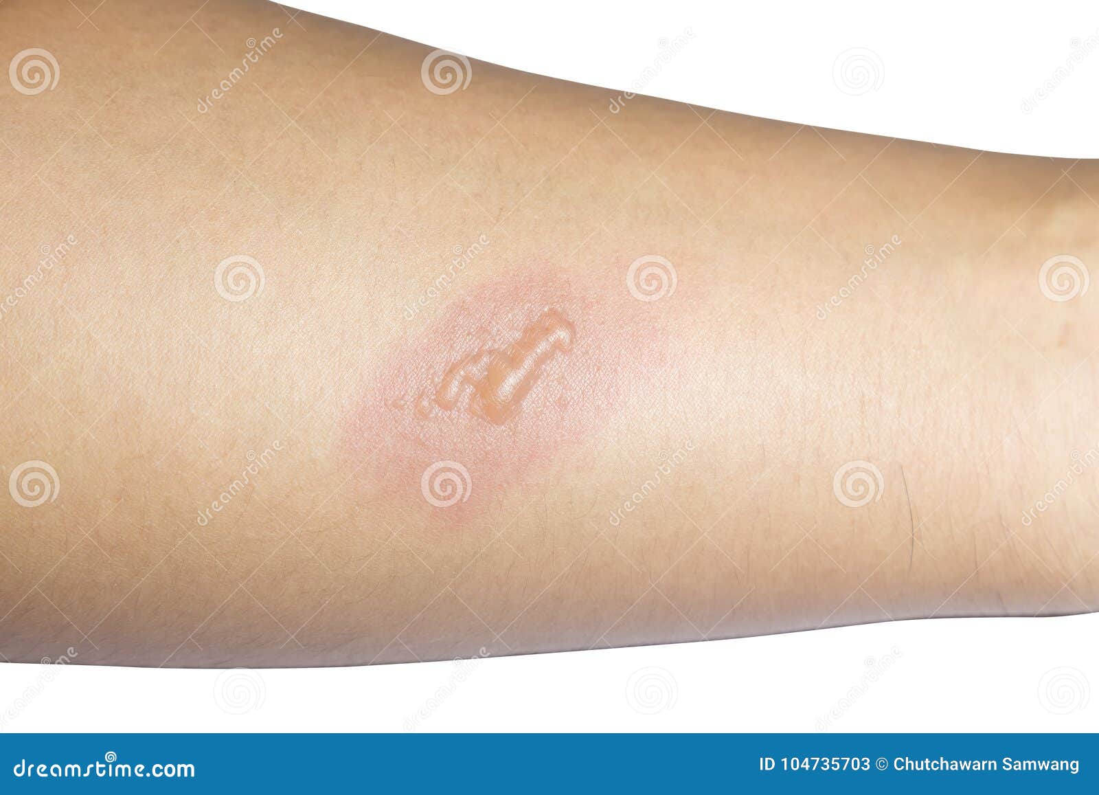 arm with blister or burn skin