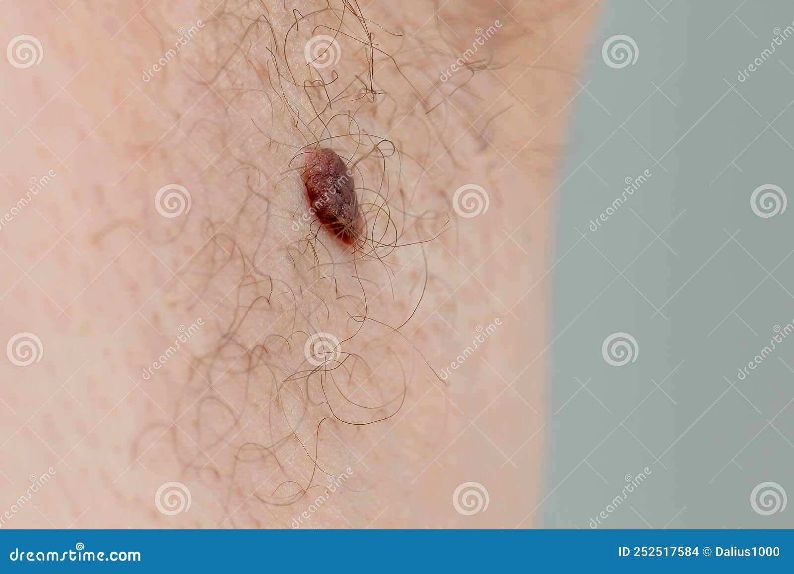 Birthmark Of The Armpit Popiloma Is Large Royalty Free Stock Photo roblox-dti-theme-mean-girl-regina-in-2024-fashion-contest