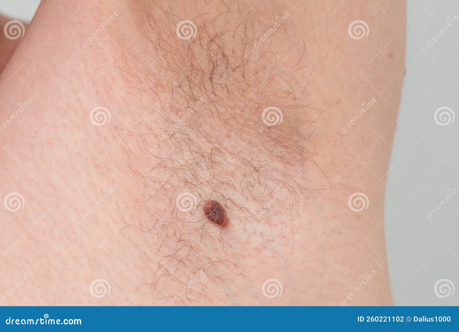 Armpit mole