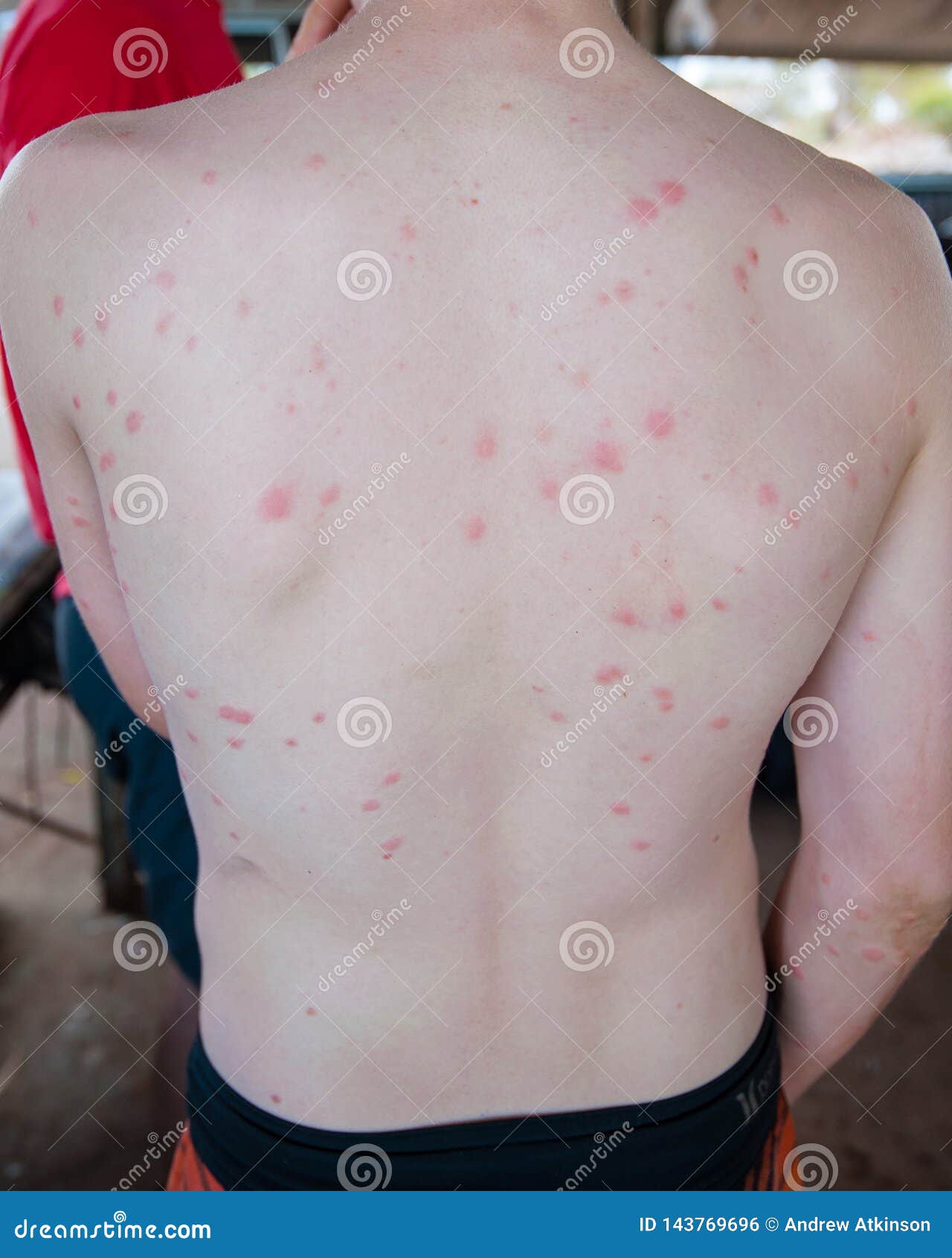 Arms and Back of a Teenage Male Covered in Midge Bites Stock Photo