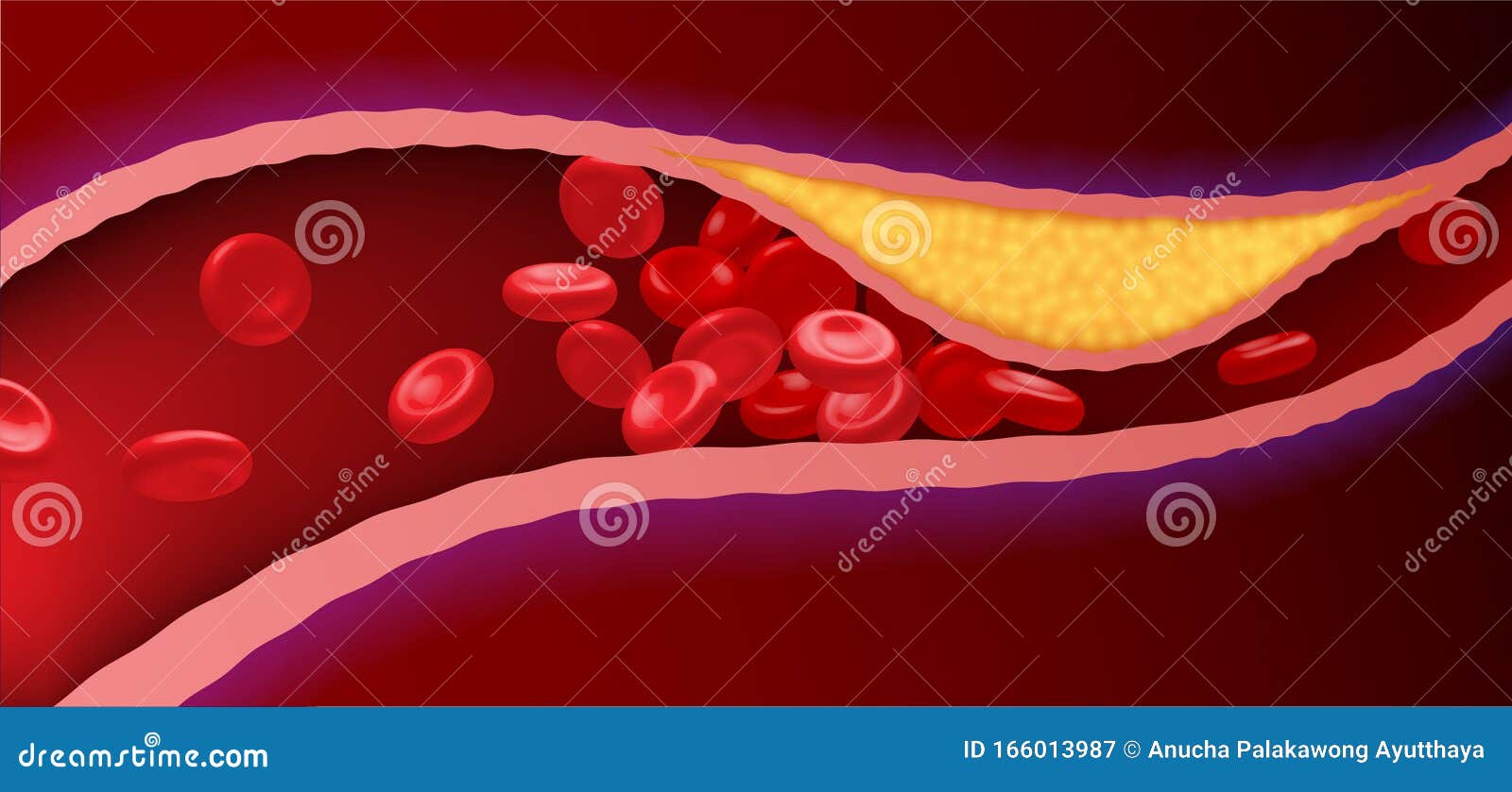Artères Avec Graisse Bouchée Qui Provoque Des Caillots Sanguins ...