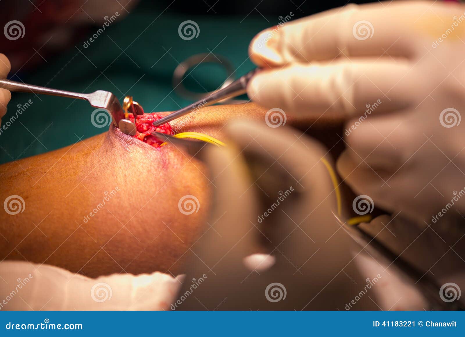 arteriovenous fistula