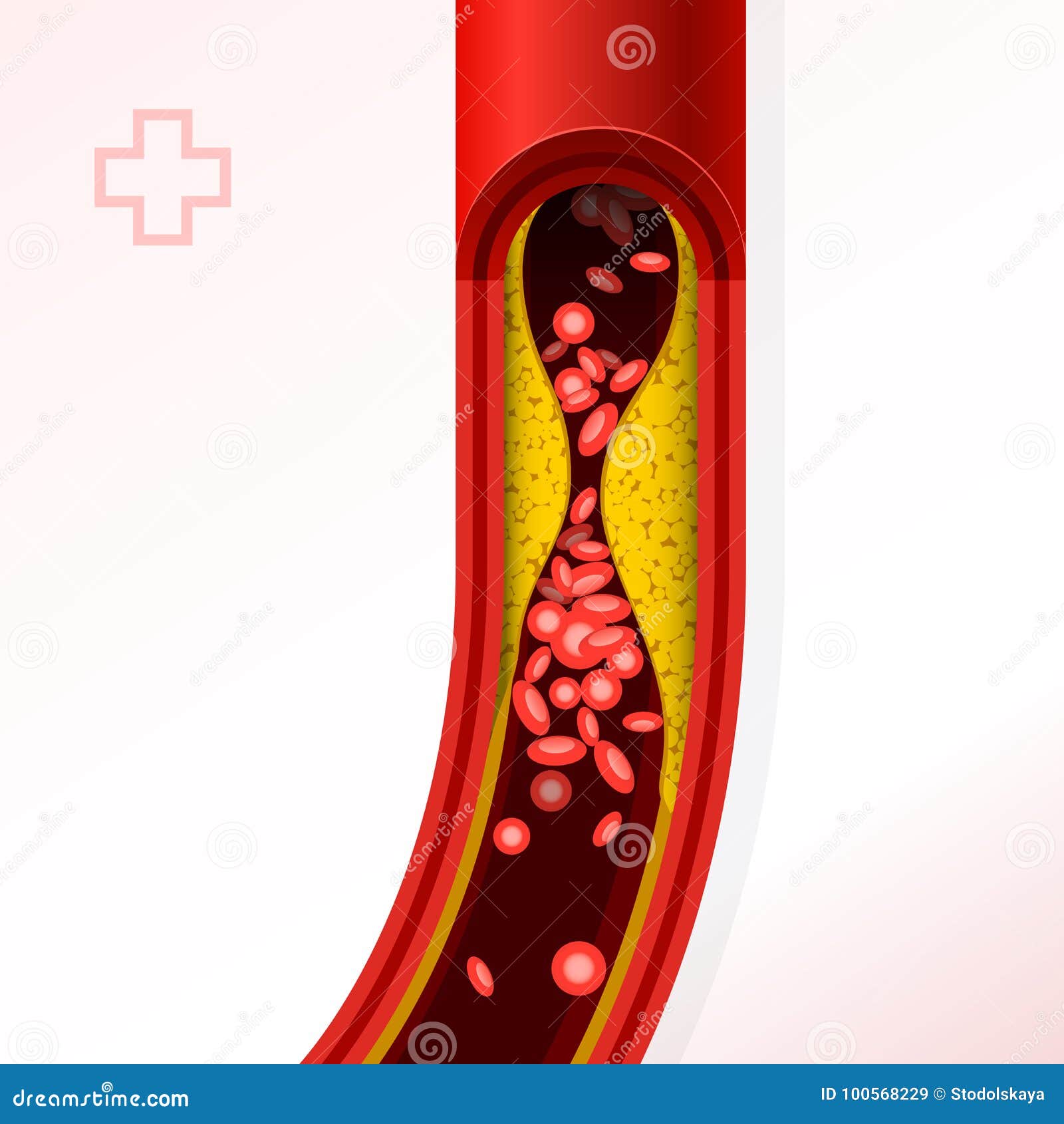 Artery with Cholesterol Buildup Cholesterol and Thromb Stock Vector
