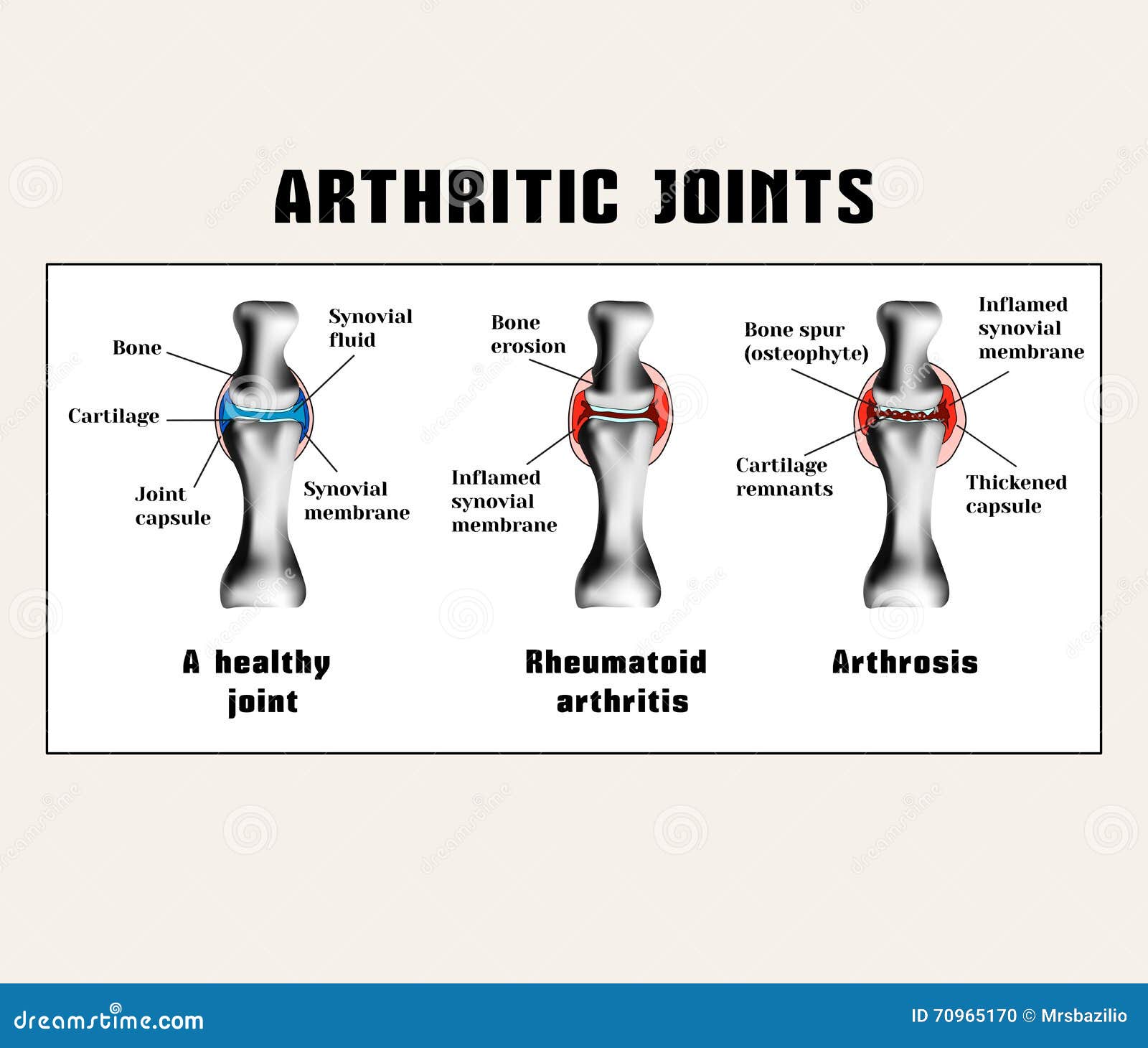 ízületek polyarthritis rheumatoid arthritis