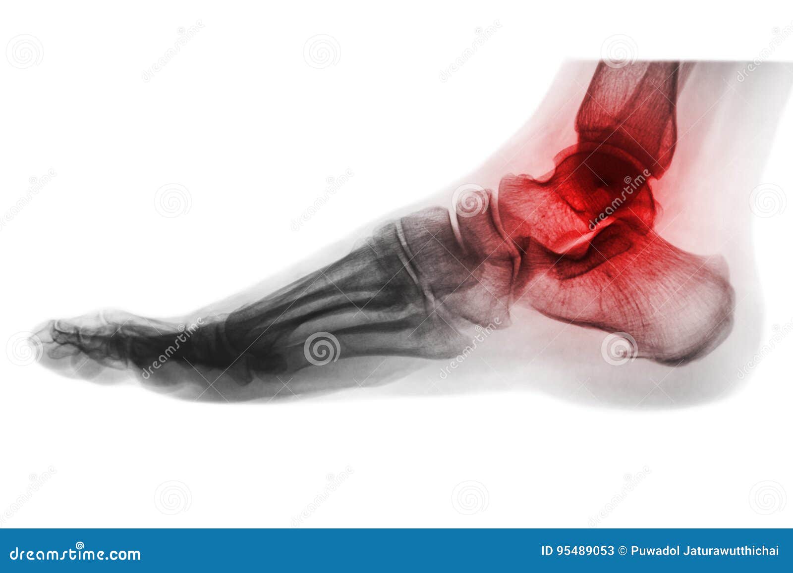 arthritis of ankle . x-ray of foot . lateral view . invert color style