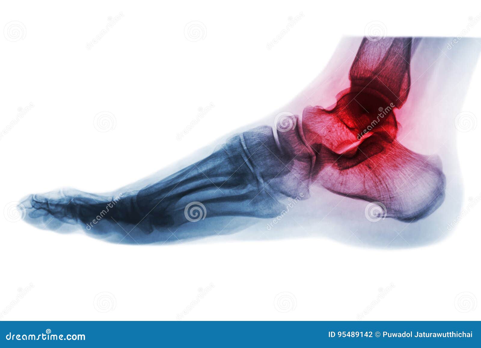 arthritis of ankle . x-ray of foot . lateral view . invert color style .