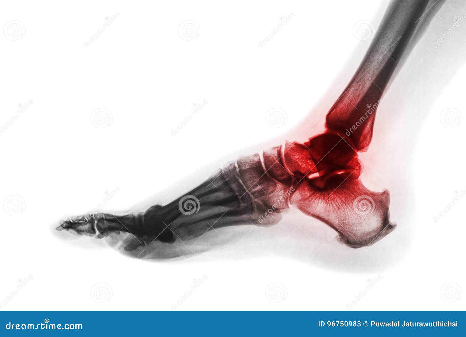 arthritis of ankle . x-ray of foot . lateral view . invert color style . gout or rheumatoid concept