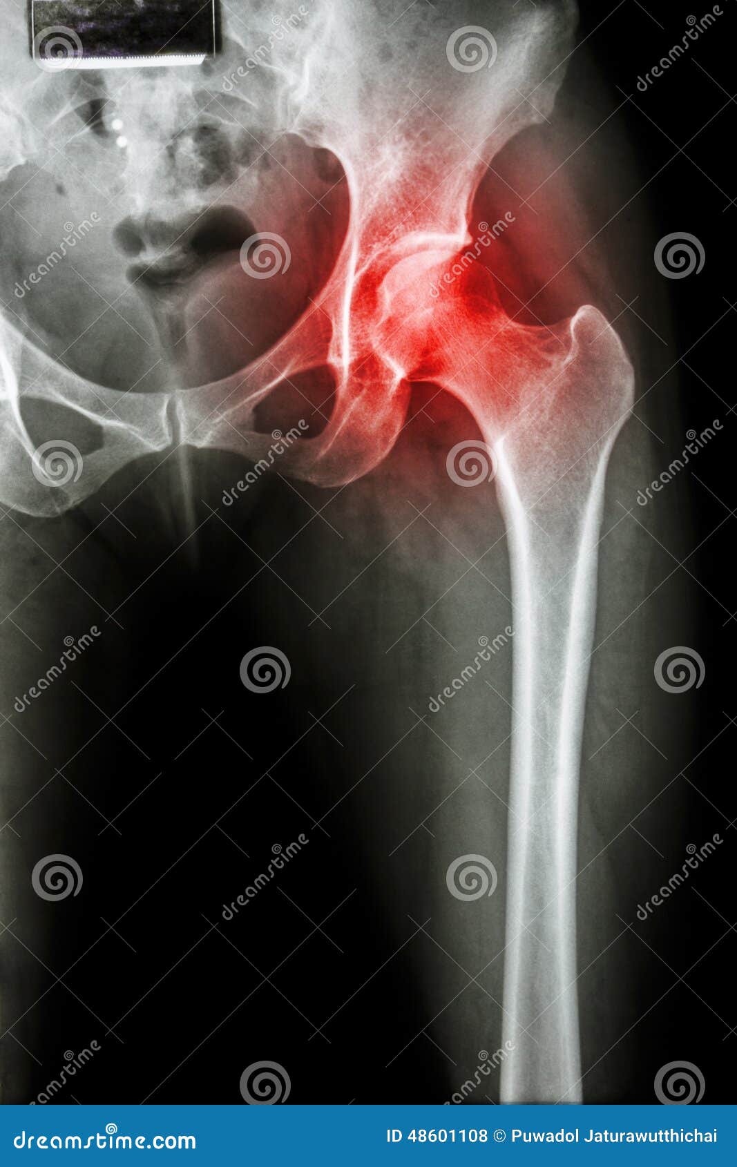 Arthritis At Hip Joint Stock Photo - Image: 48601108