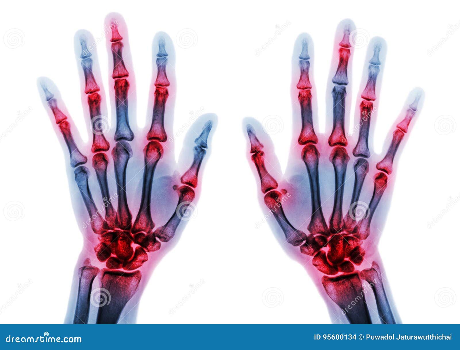 arthritis multiple joint of fingers . film x-ray of both hands and wrists