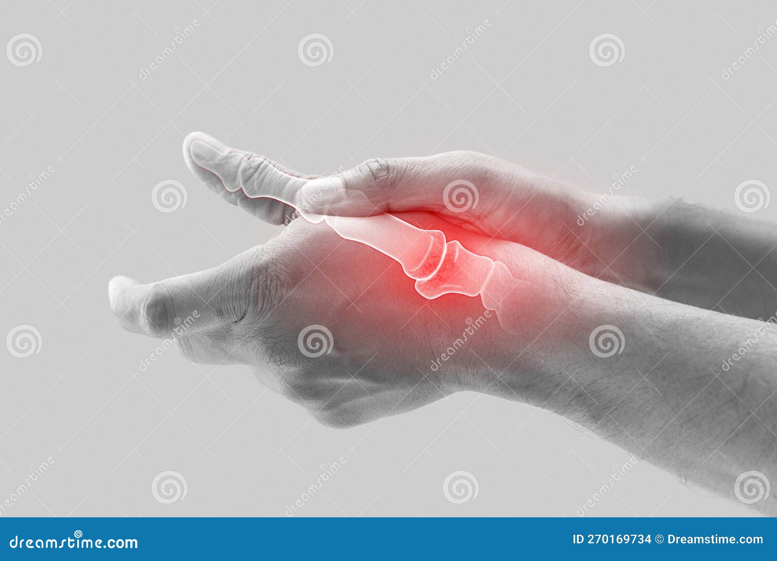 Arthritis of thumb joint. stock photo. Image of fingertips 270169734