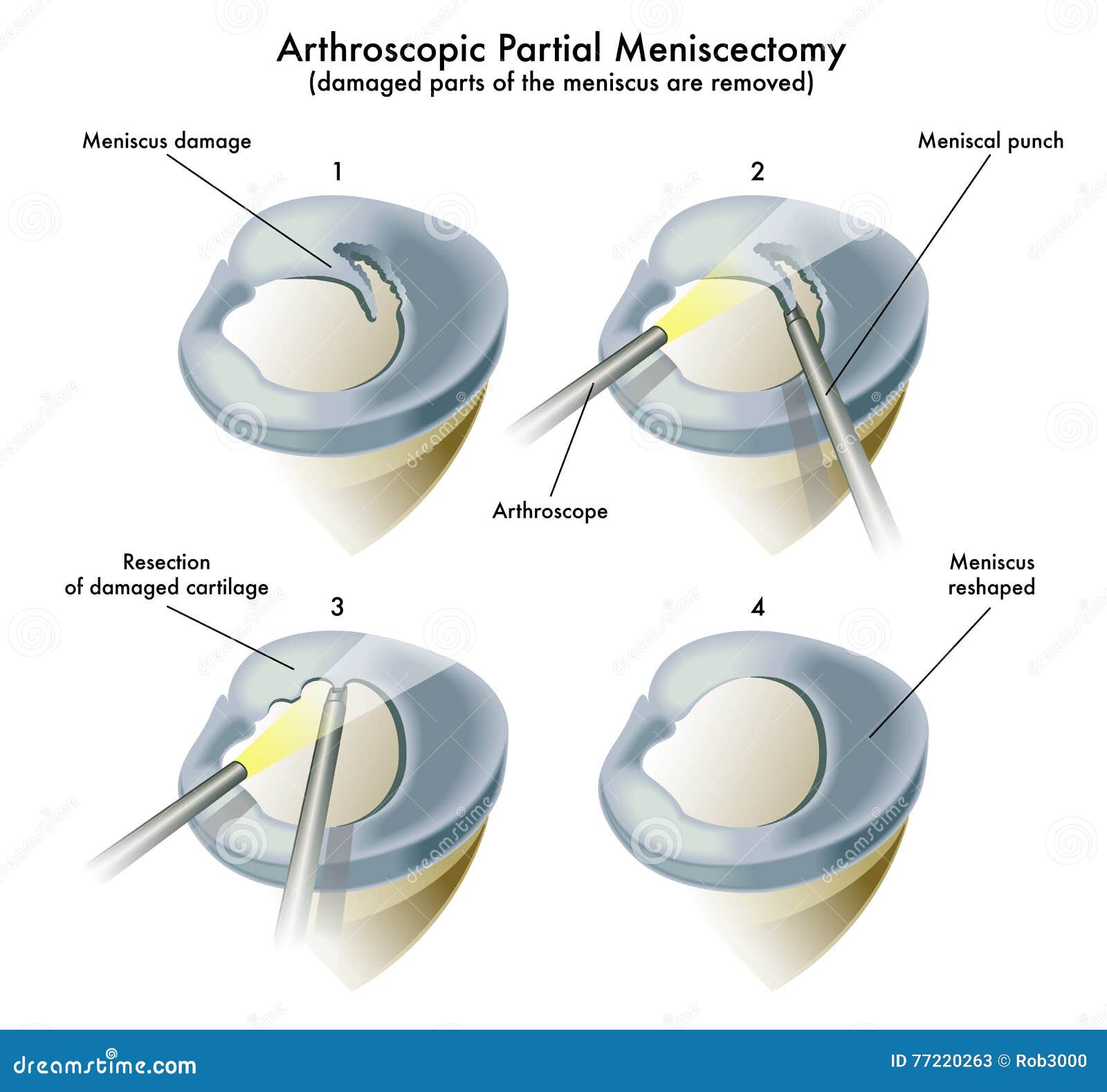 Arthroscopic Partial Meniscectomy Cartoon Vector CartoonDealer arthroscopic-partial-meniscectomy-cartoon-vector-cartoondealer