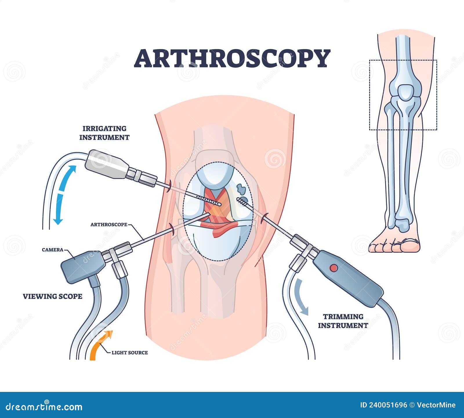 arthroscopy procedure as knee diagnostics process explanation outline diagram