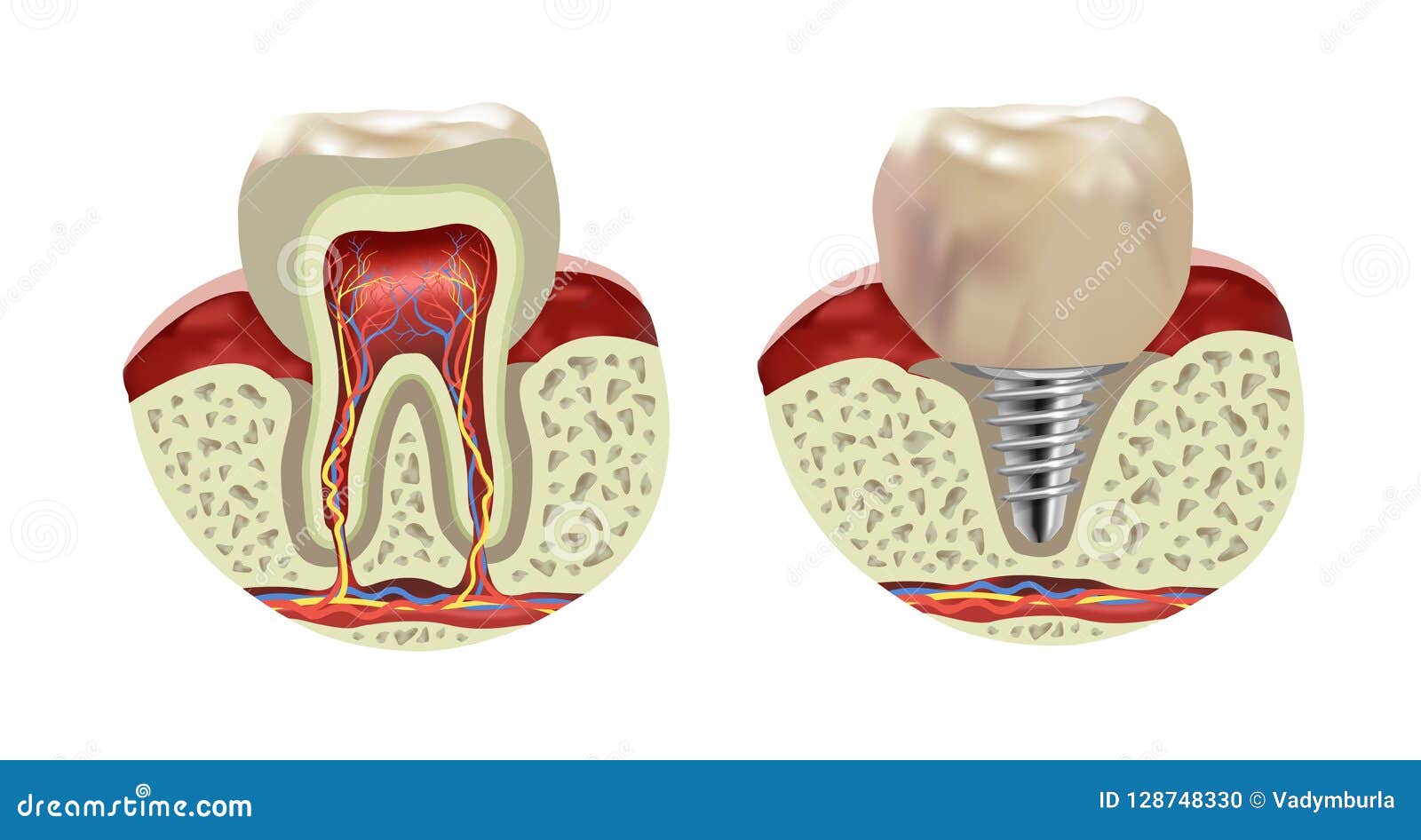 Artificial Human Tooth Implant Cross Section Realistic View Stock