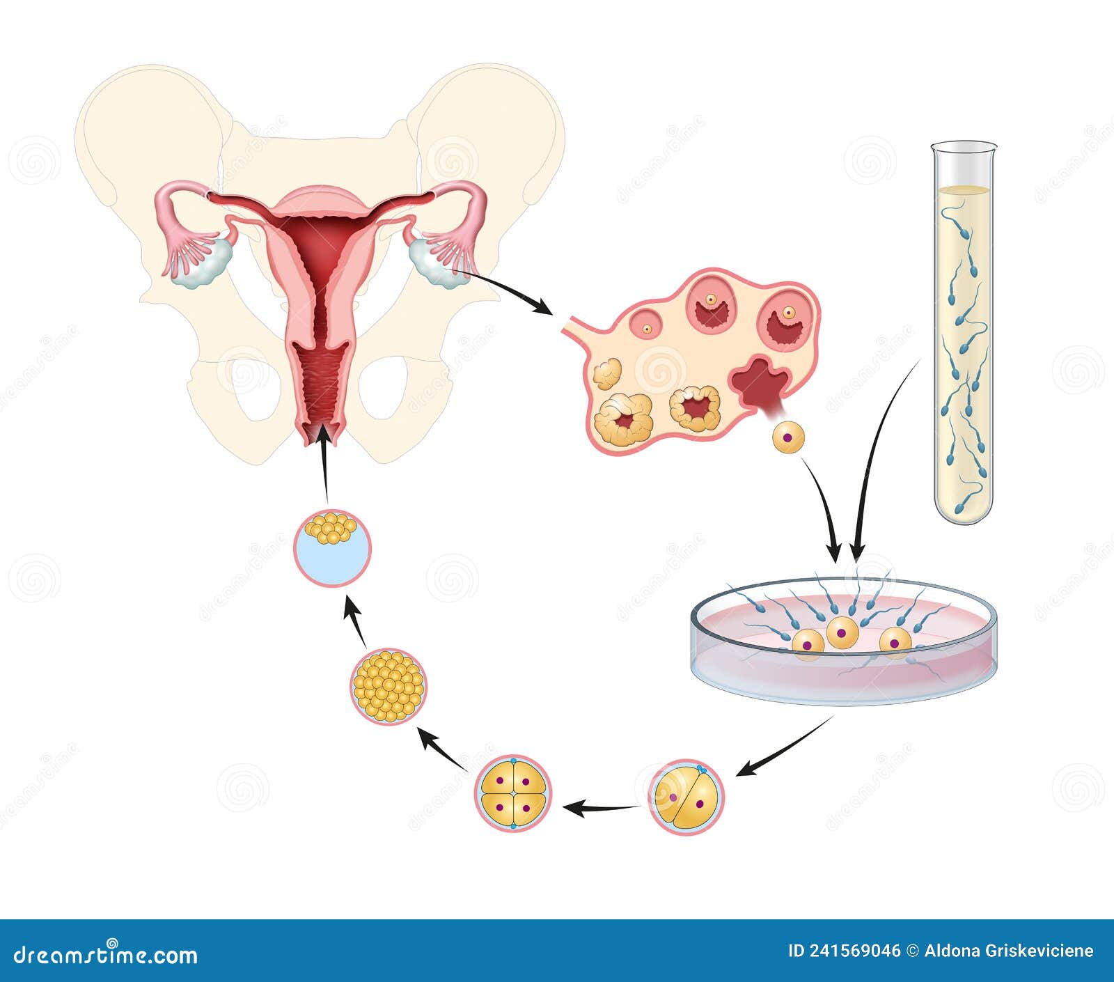 artificial insemination. in vitro fertilization. 