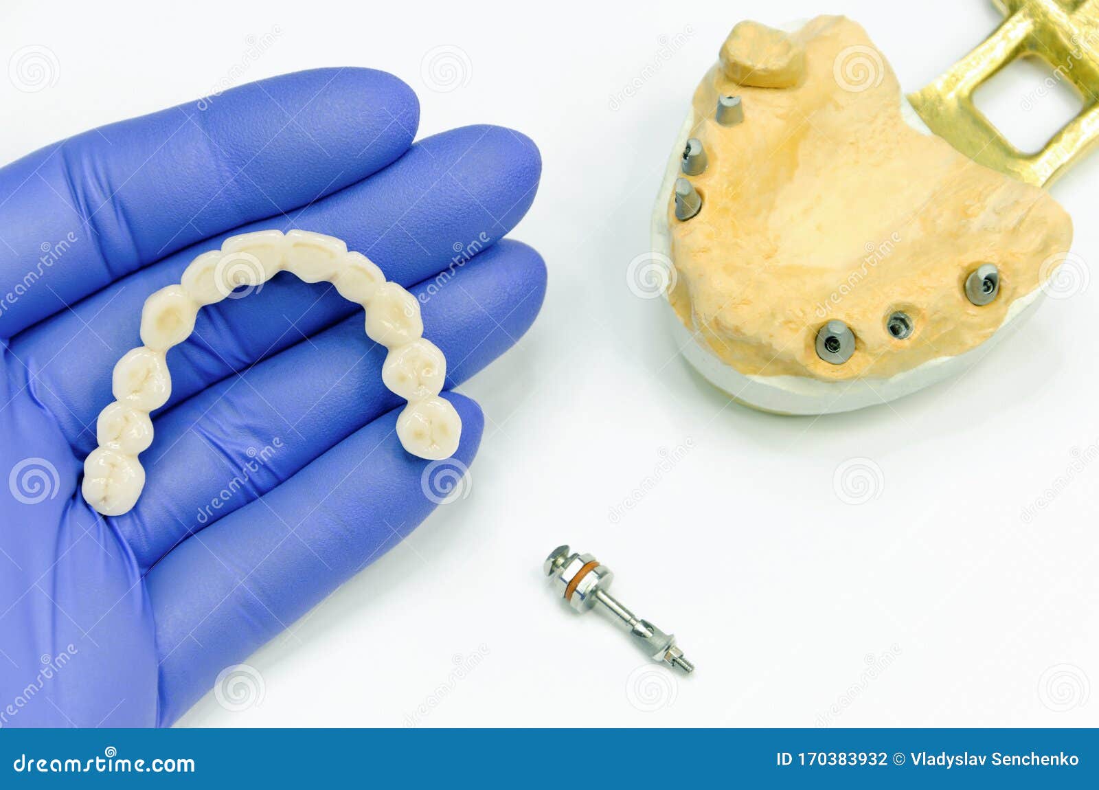 Artificial Teeth in the Dentist`s Hand. Ceramic Dental Bridge for Prosthetics on Dental Implants