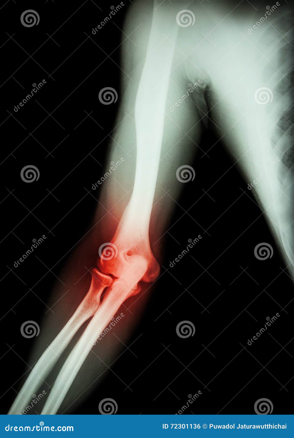 609 Fotos de Stock de Cotovelo Do Raio X - Fotos de Stock Gratuitas e Sem  Fidelização a partir da Dreamstime, image size:1134x1690