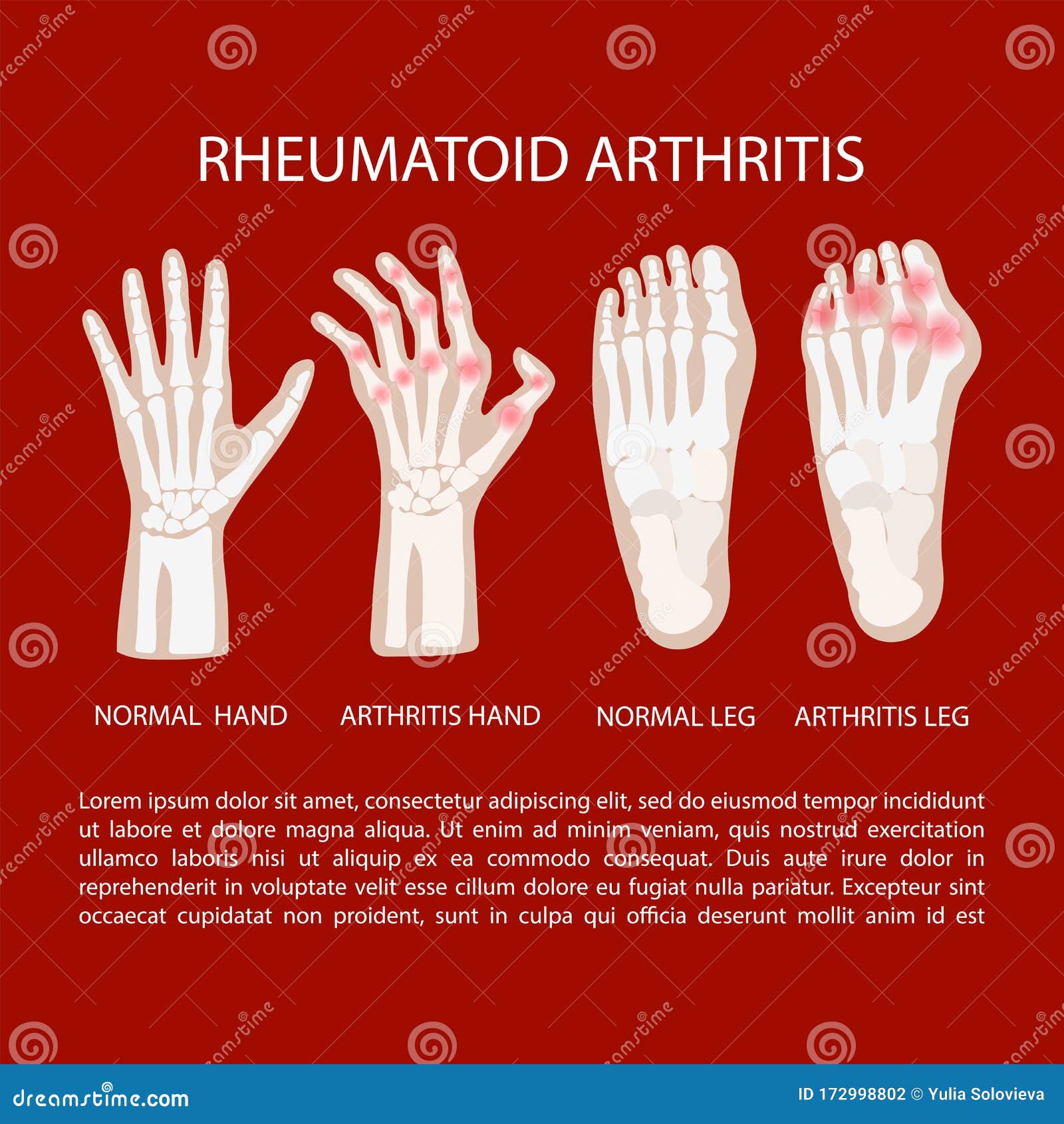 artritis leg hand rheumatoid medicine education  scheme