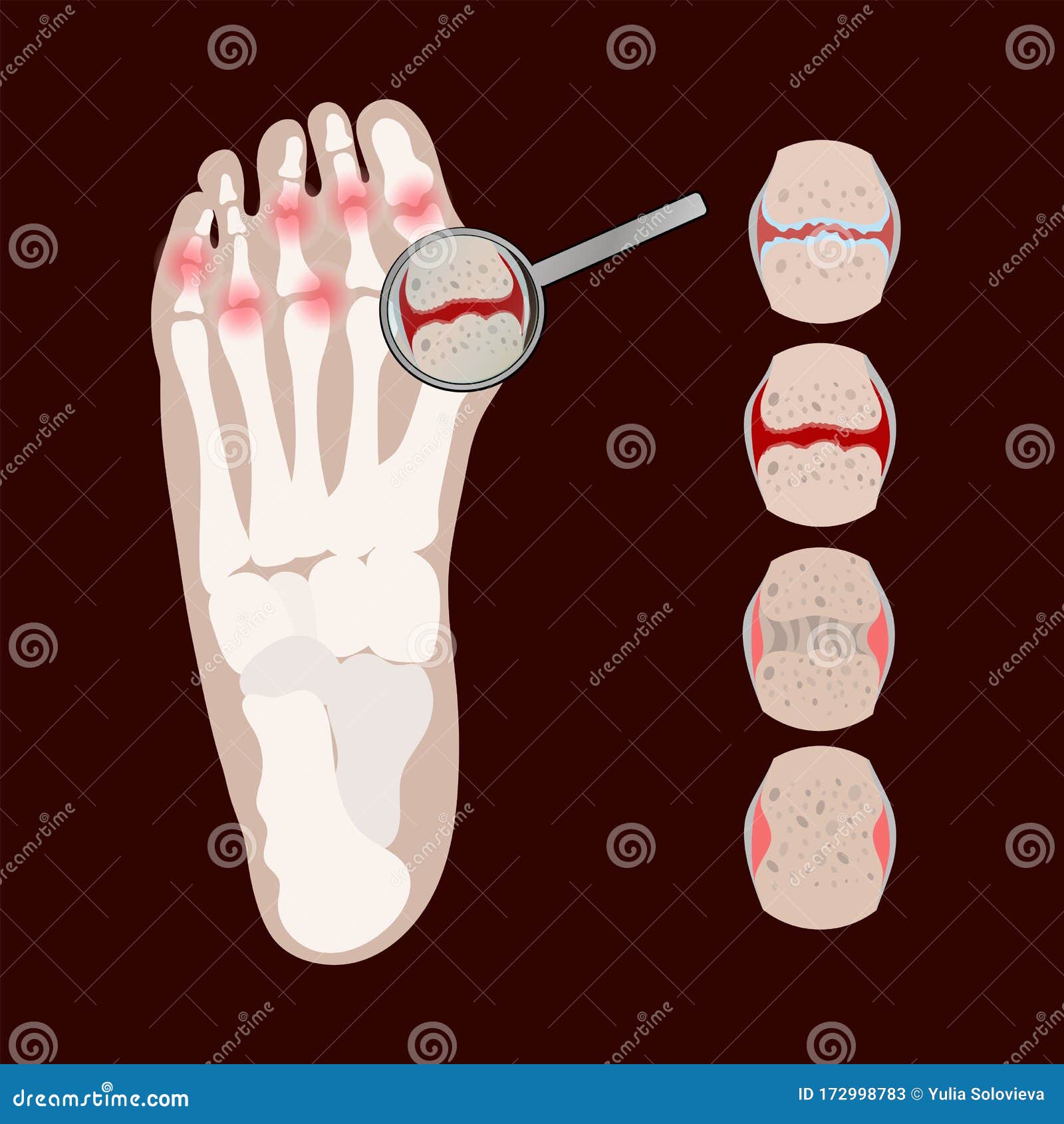 artritis leg rheumatoid medicine education  scheme set