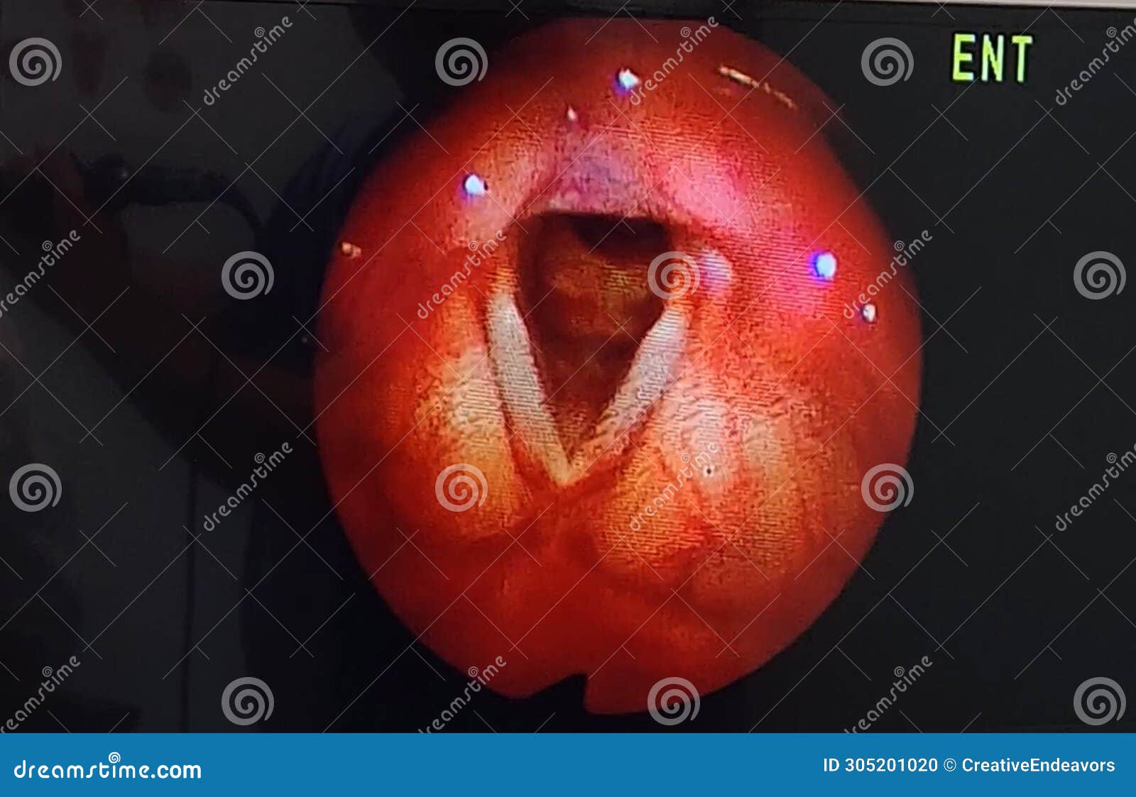 arytenoids, vocal cords as seen through laryngoscope