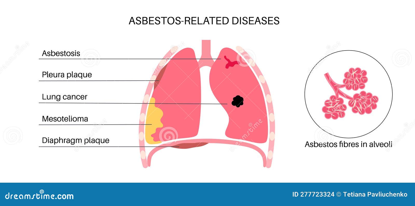 Asbestos Related Diseases Vector Illustration CartoonDealer asbestos-related-diseases-vector-illustration-cartoondealer