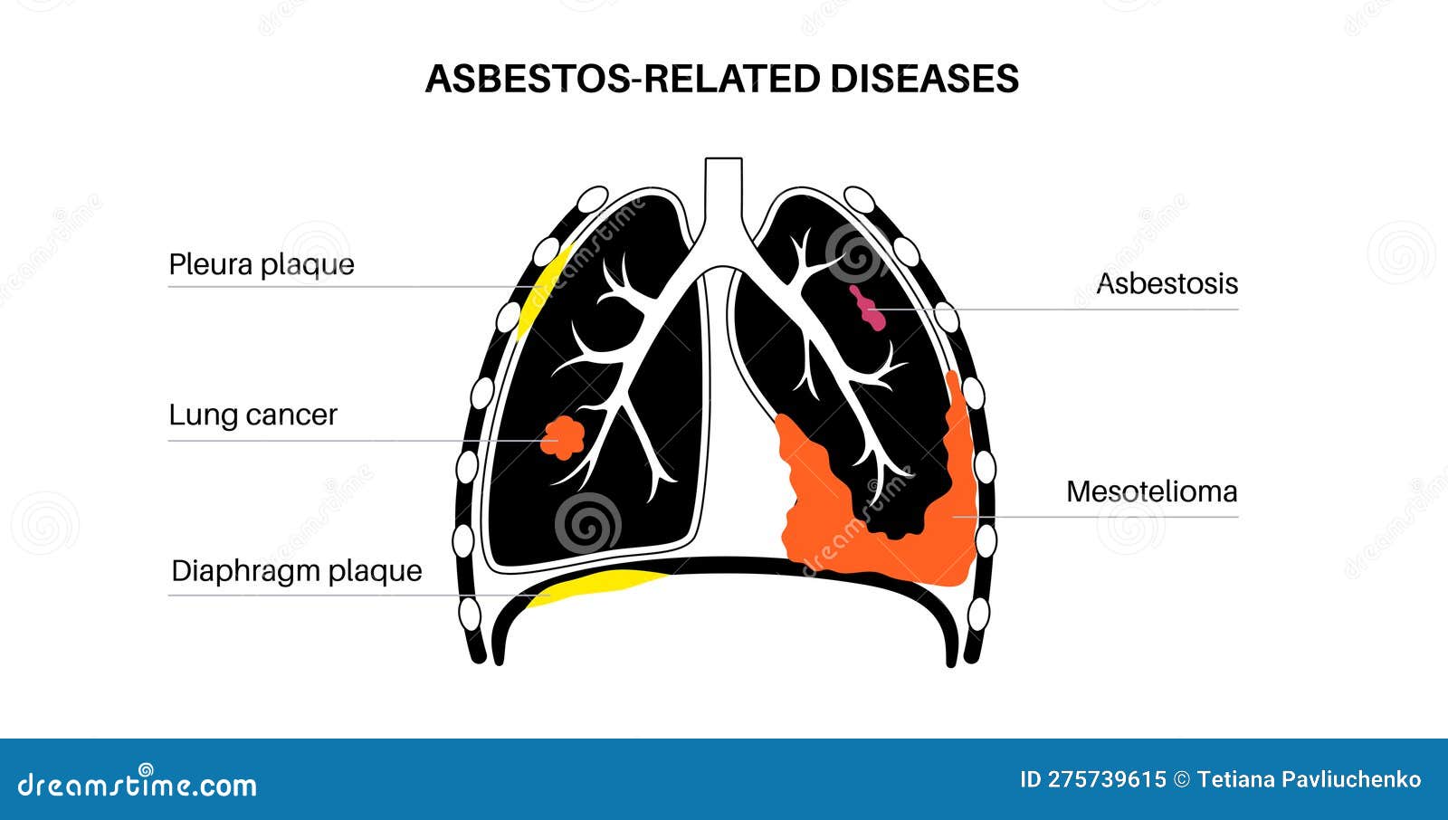 Asbestos Related Diseases Vector Illustration CartoonDealer asbestos-related-diseases-vector-illustration-cartoondealer