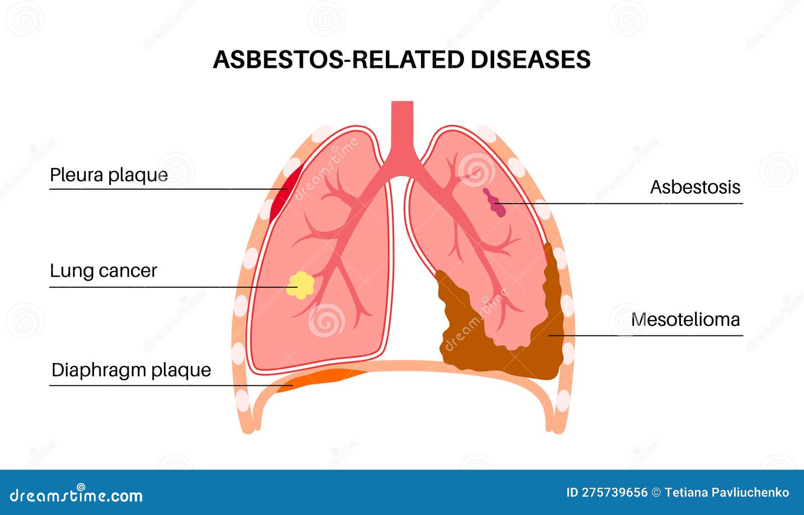 Asbestos Related Diseases Vector Illustration CartoonDealer asbestos-related-diseases-vector-illustration-cartoondealer