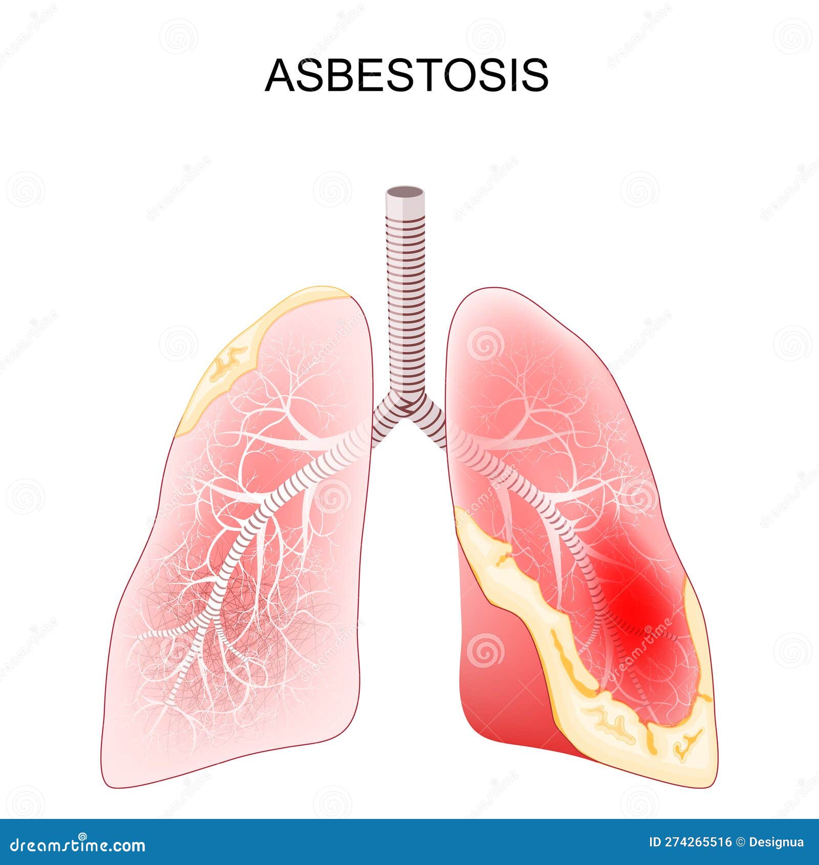asbestosis. close-up of a cross section of human lungs with fibrosis and scarring