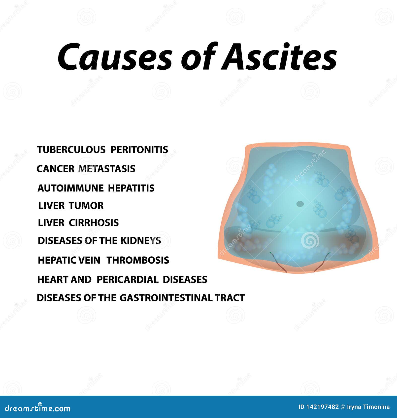 Ascites