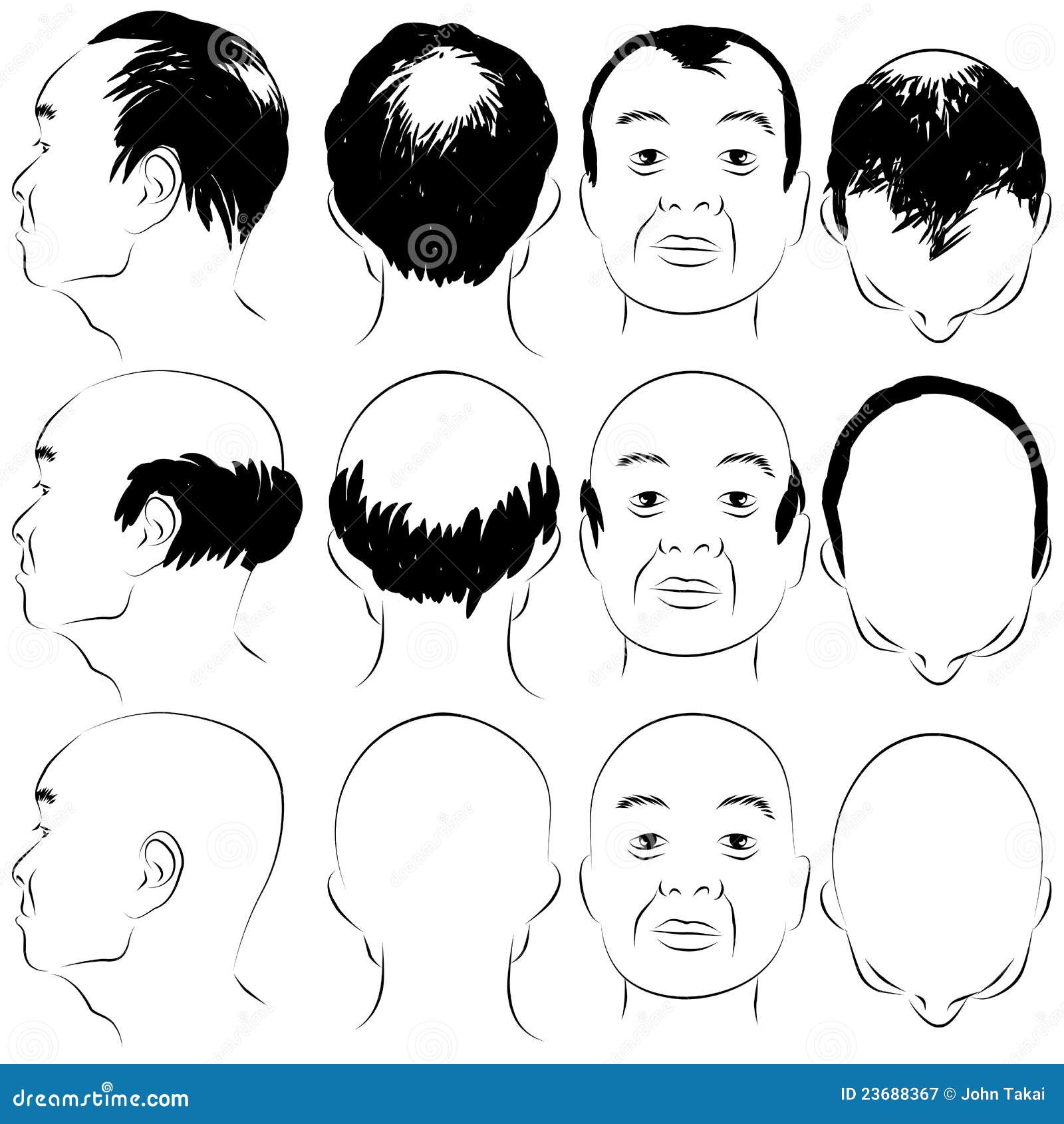 asian male baldness pattern