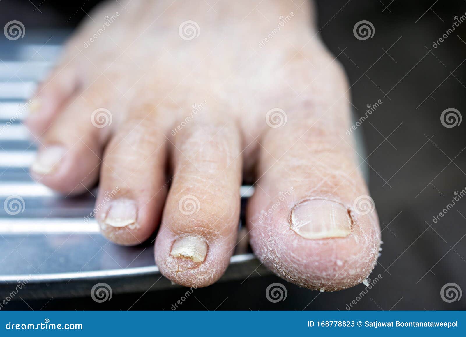 asian senior woman have dry, cracked feet and broken nails in the elderly,old people dry skin, lack of nourishment, lack of