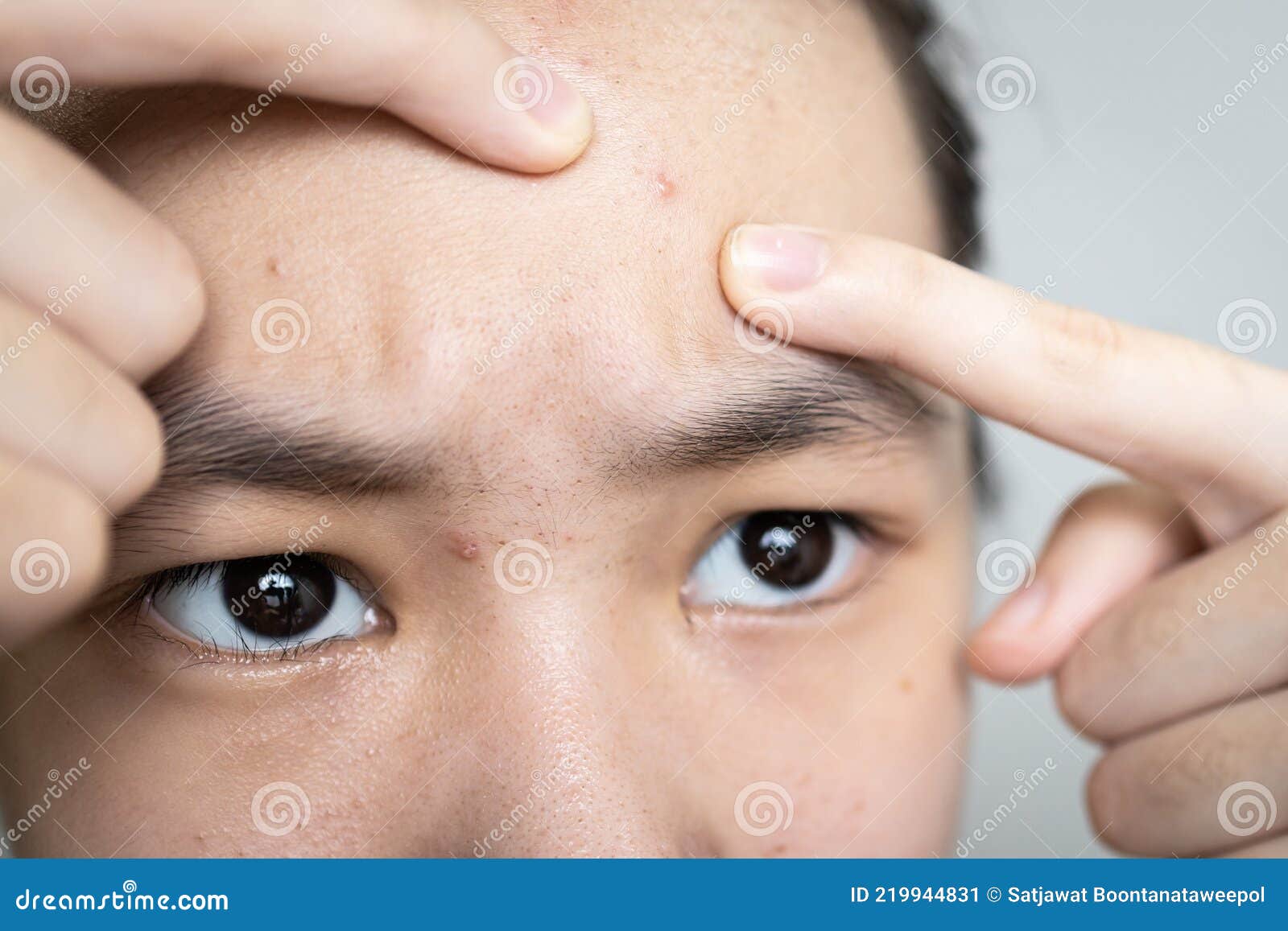 Asian Teen Girl Squeezing Pimples with Fingers on Her Forehead,popping a  Pimple on Face,a Plug of Sebum in a Hair Follicle Causes Stock Image -  Image of hormonal, face: 219944831
