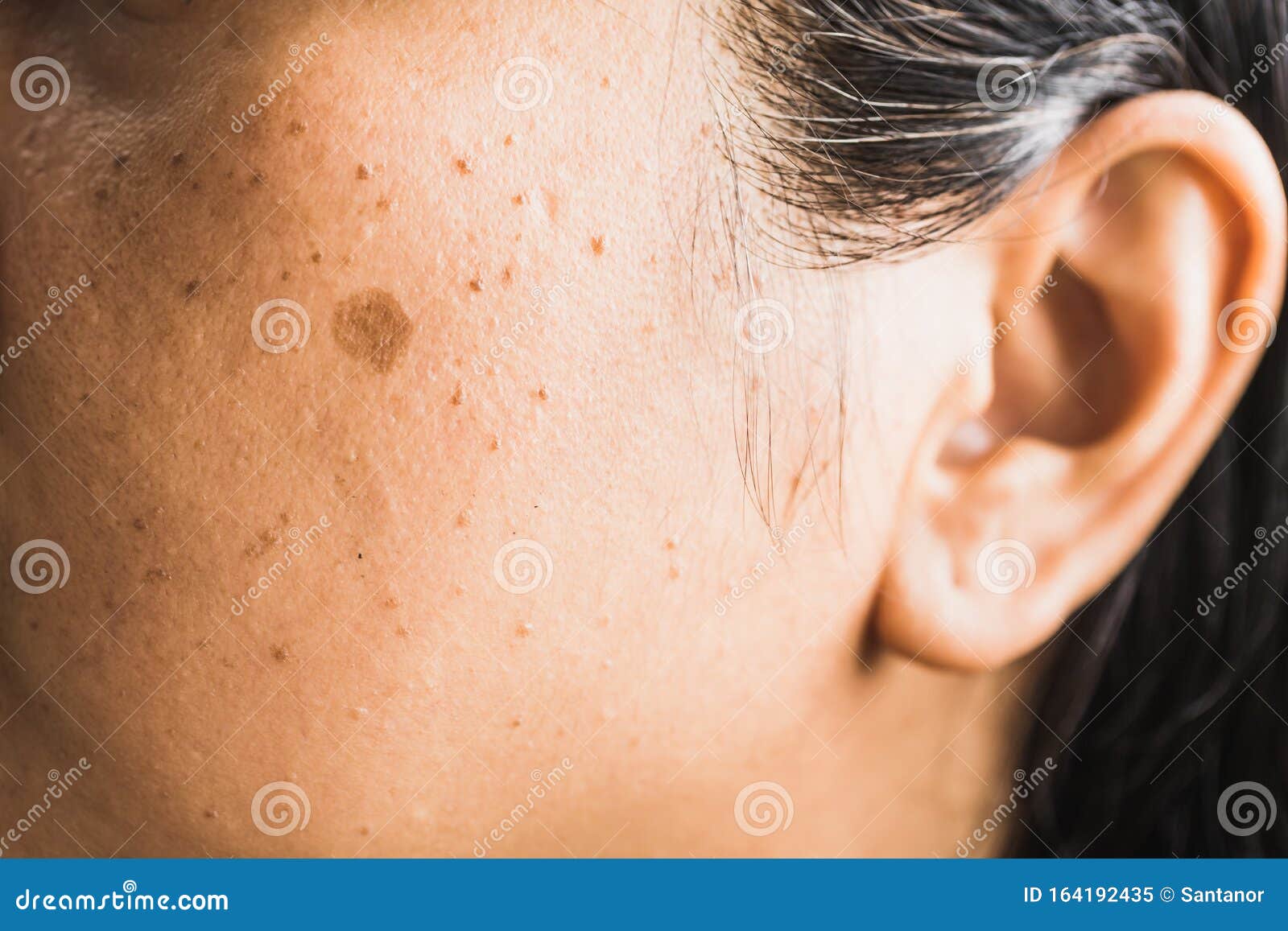 Asian Woman Has A Mole Stock Image Image Of Asian Spot 164192435