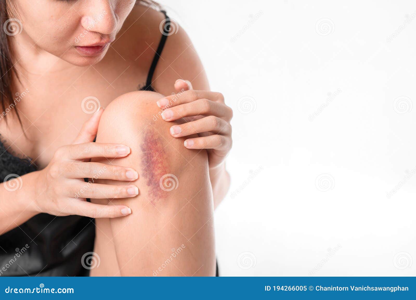 varicoza bruise photo