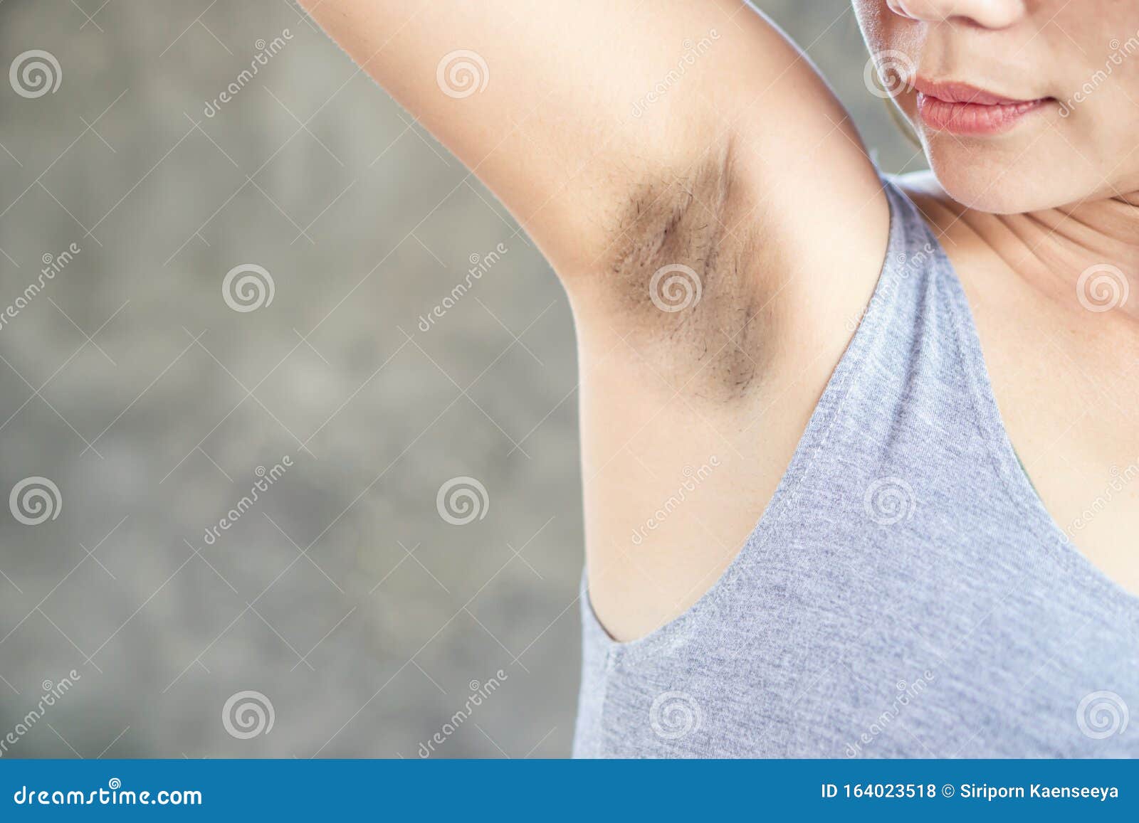 asian woman having problem fat skin  underarm and black armpit