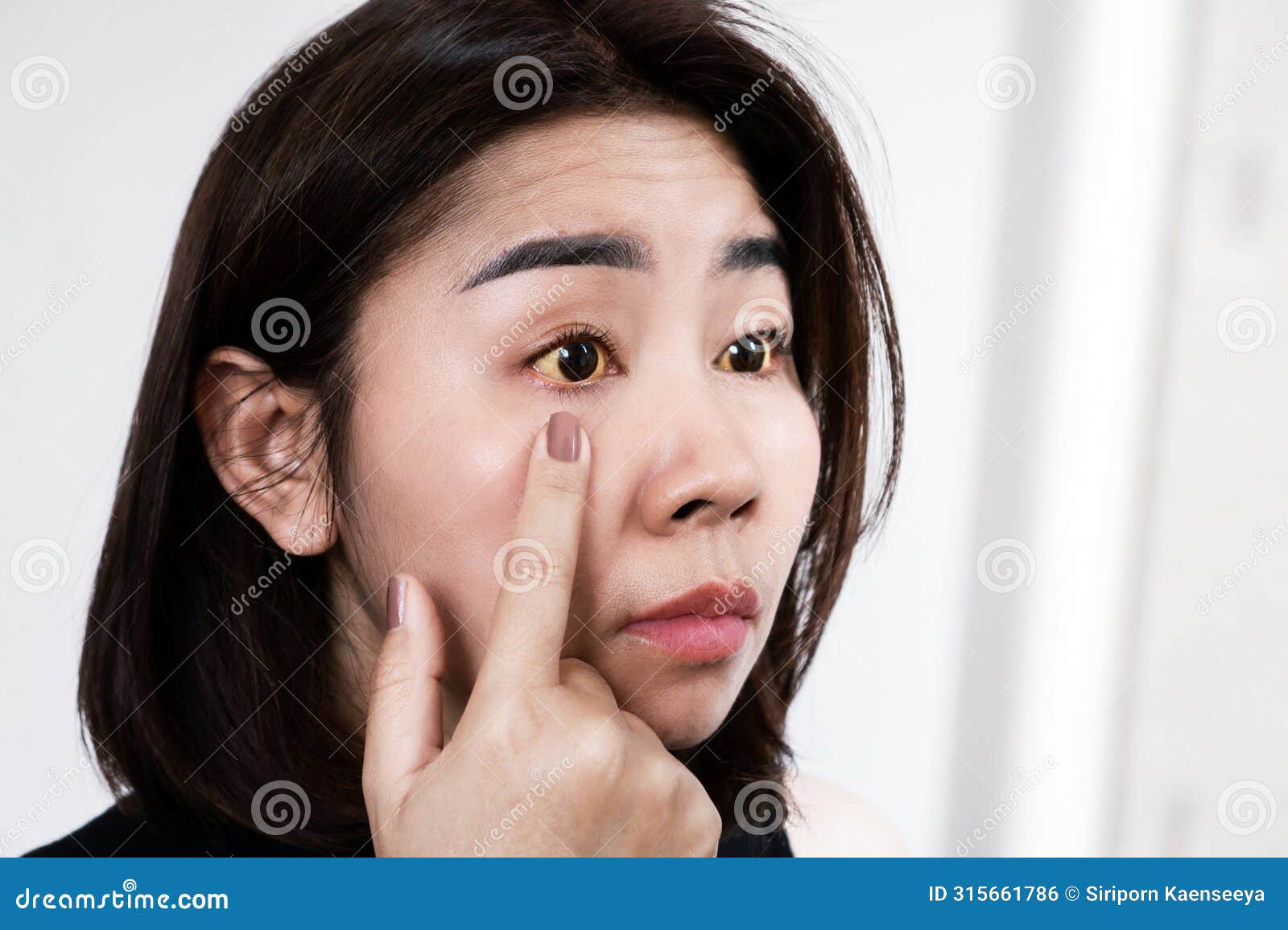asian woman having yellow eyes concept of jaundice eyes or viral hepatitis