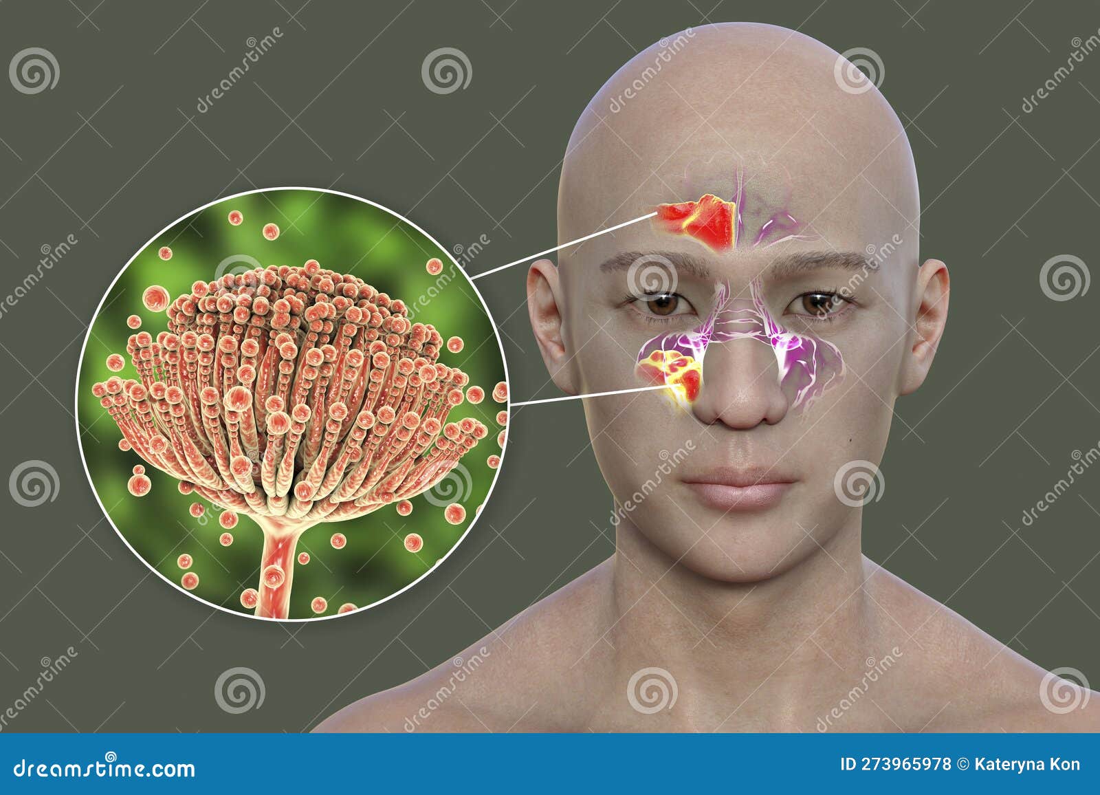 Aspergillus Fungi As A Cause Of Sinusitis, 3D Illustration