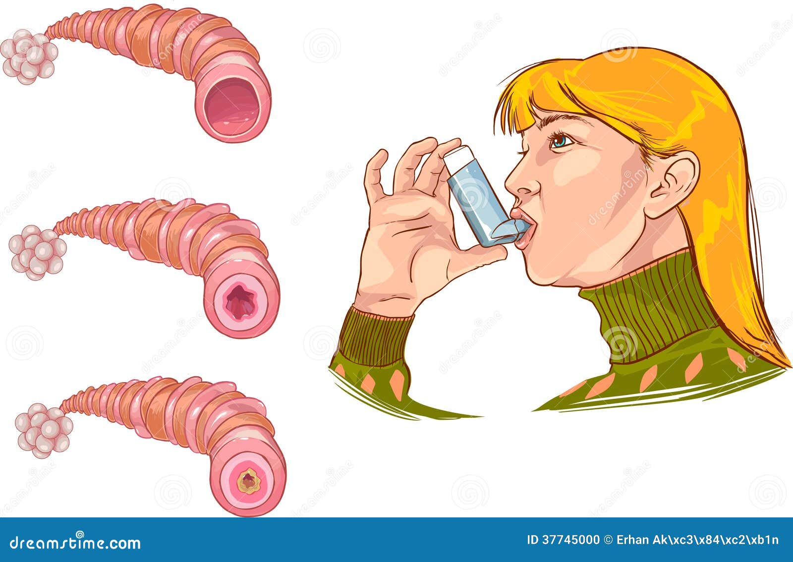 Asthma Pathology Cartoon Vector | CartoonDealer.com #58859085