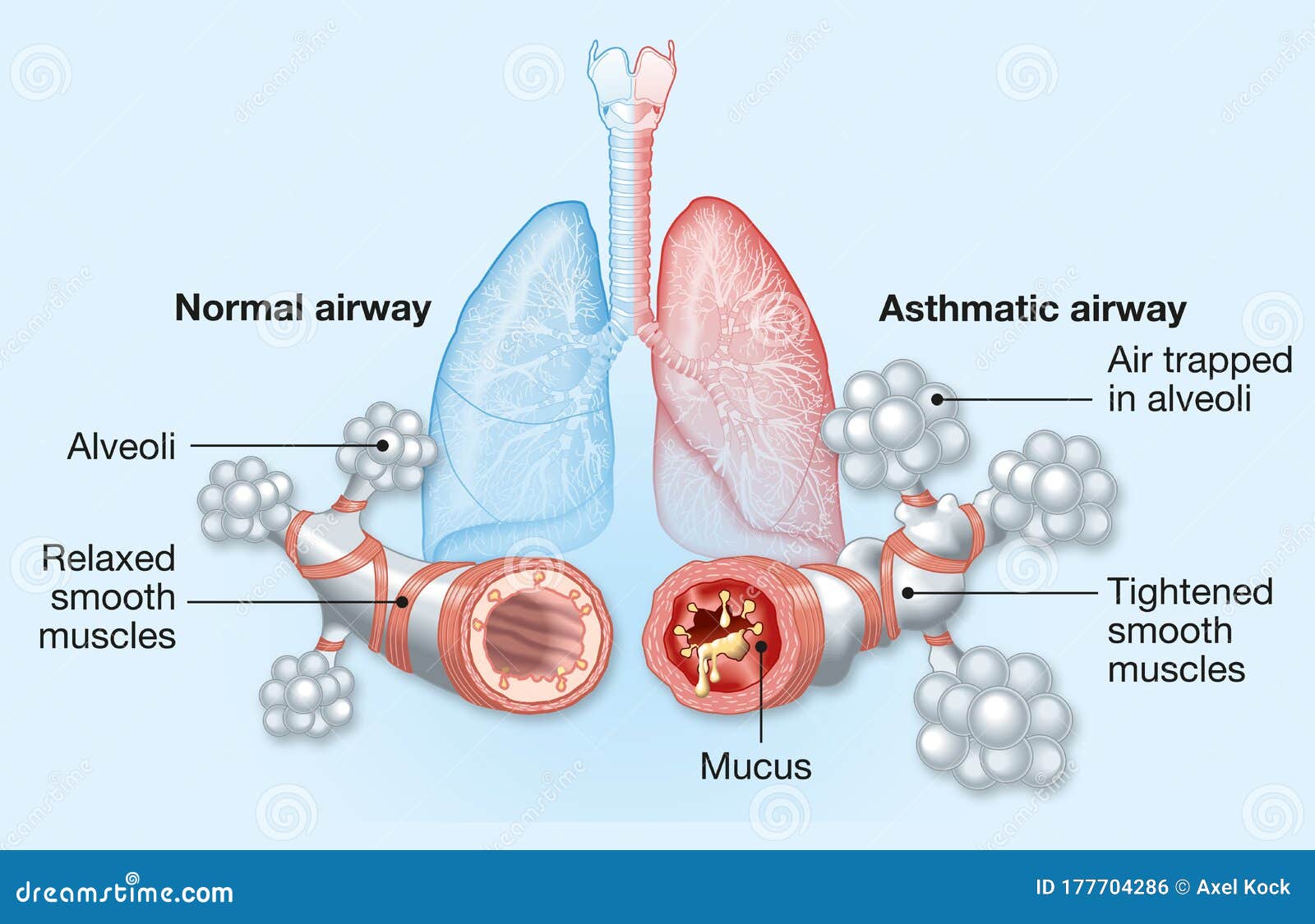 asthma, normal and asthmatic airways, medically 