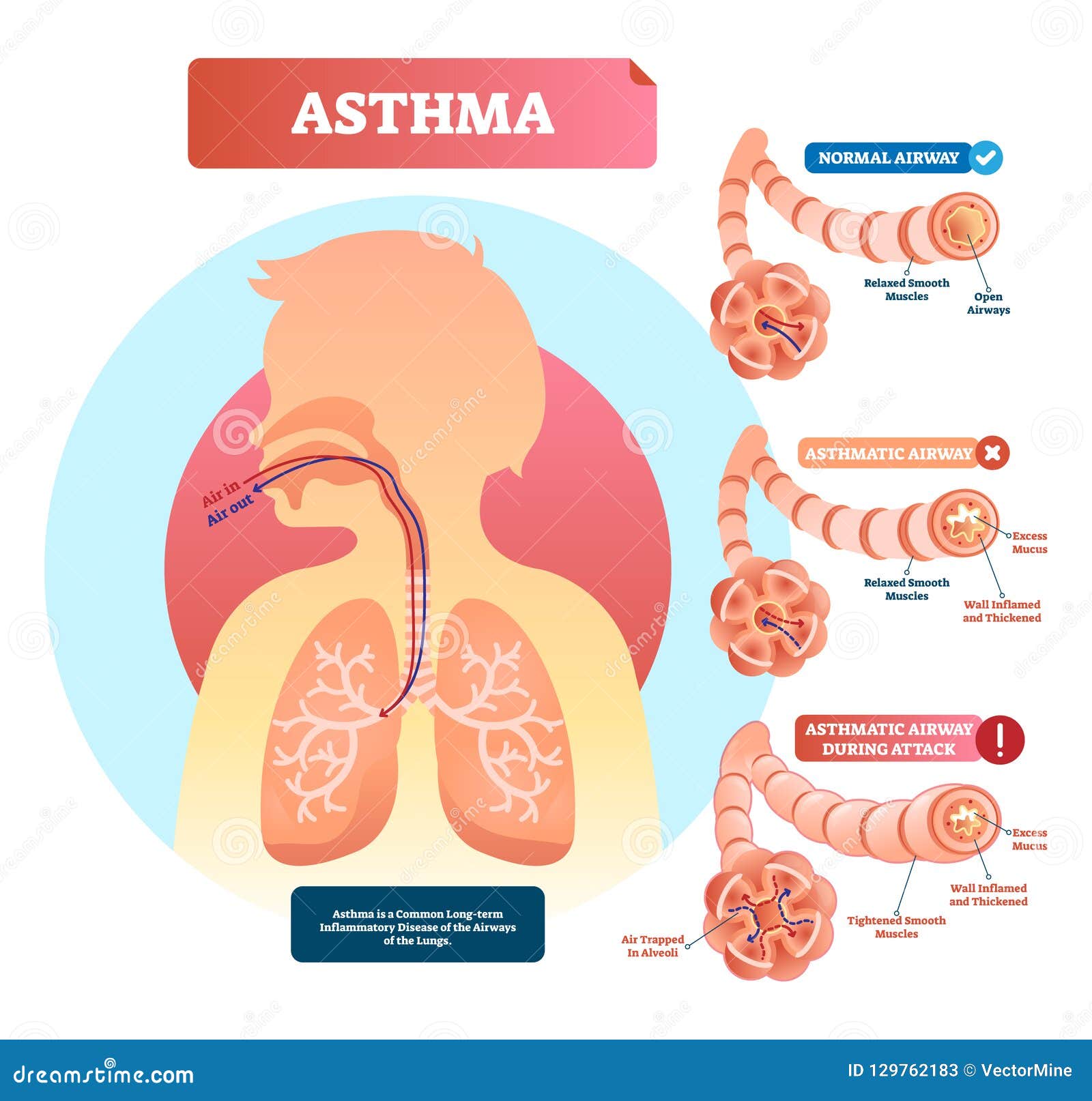 asthma  . disease with breathing problems diagram..