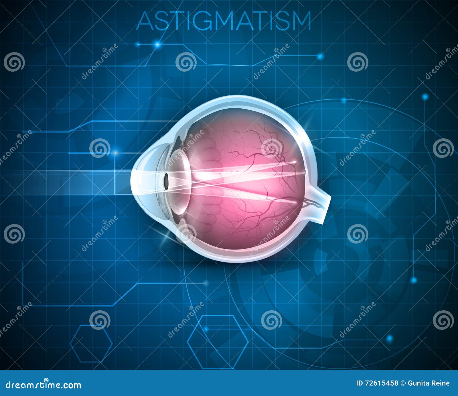 astigmatism la 100 de viziuni)