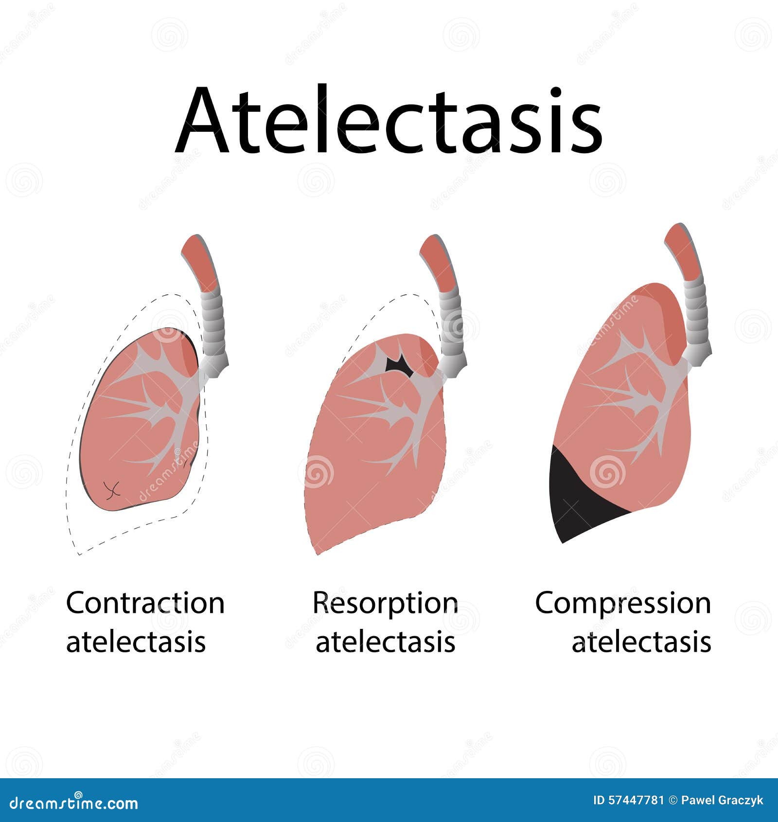 atelectasis