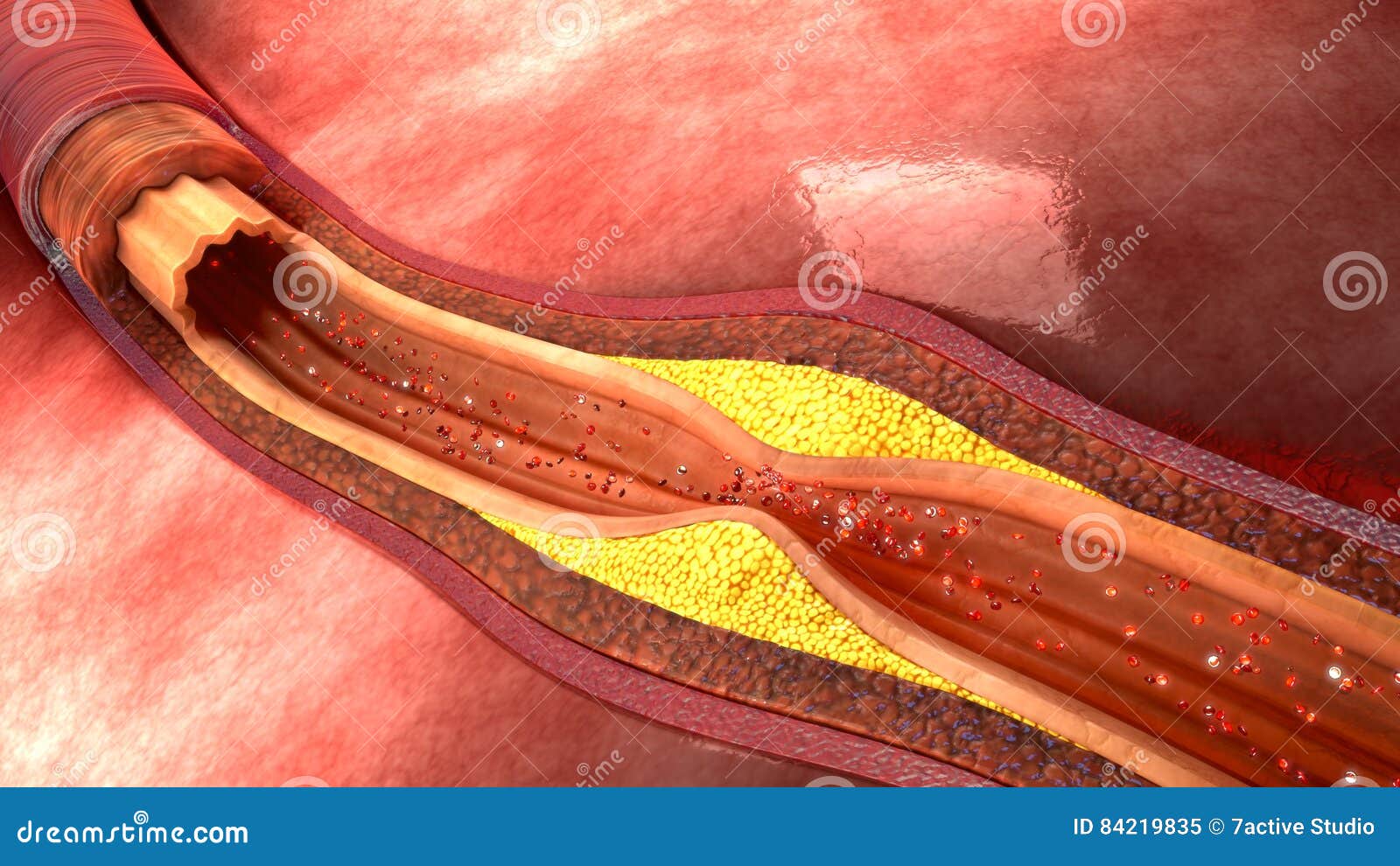 atherosclerosis