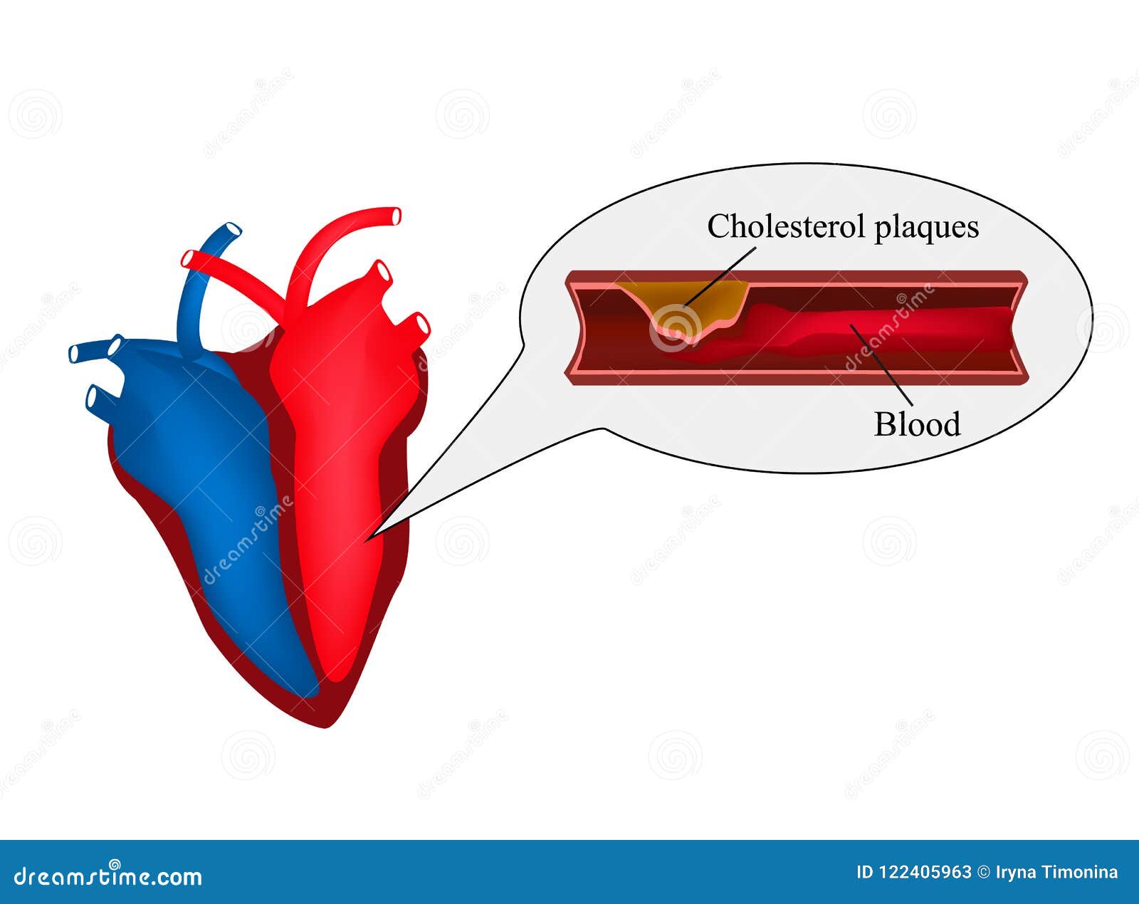Atherosclerosis of the Heart. Angina Pectoris. Heart Disease. World