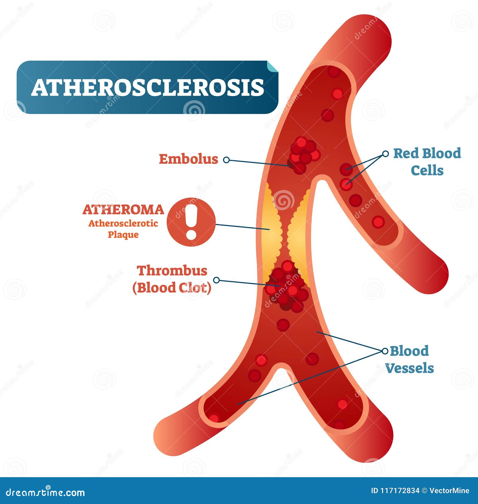 atherosclerosis-medical-vector-illustration-cross-section-diagram-unhealthy-blood-vessel